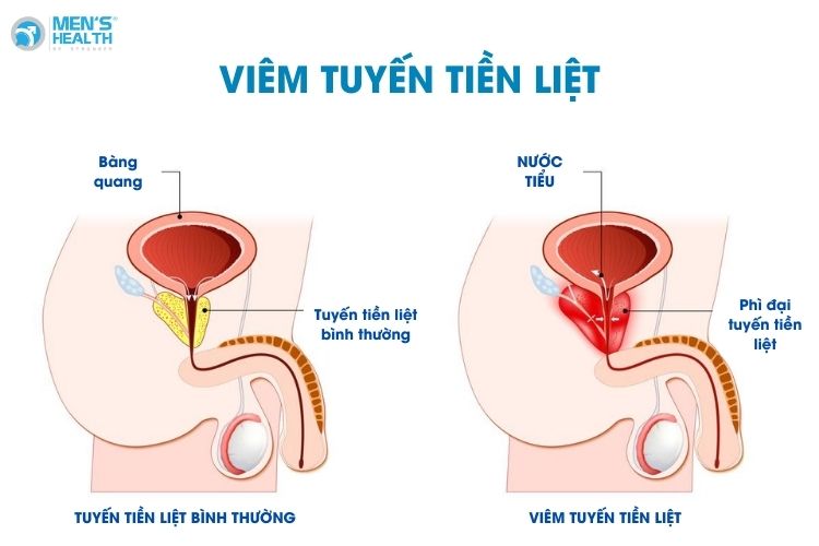 Viêm tuyến tiền liệt là bệnh lý đặc trưng ở nam giới
