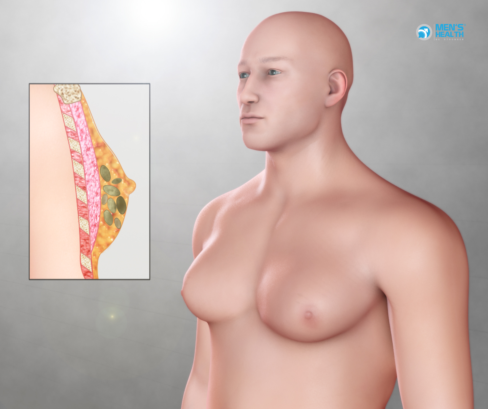 Đại Cương Về Nữ Hóa Tuyến Vú (Gynecomastia)