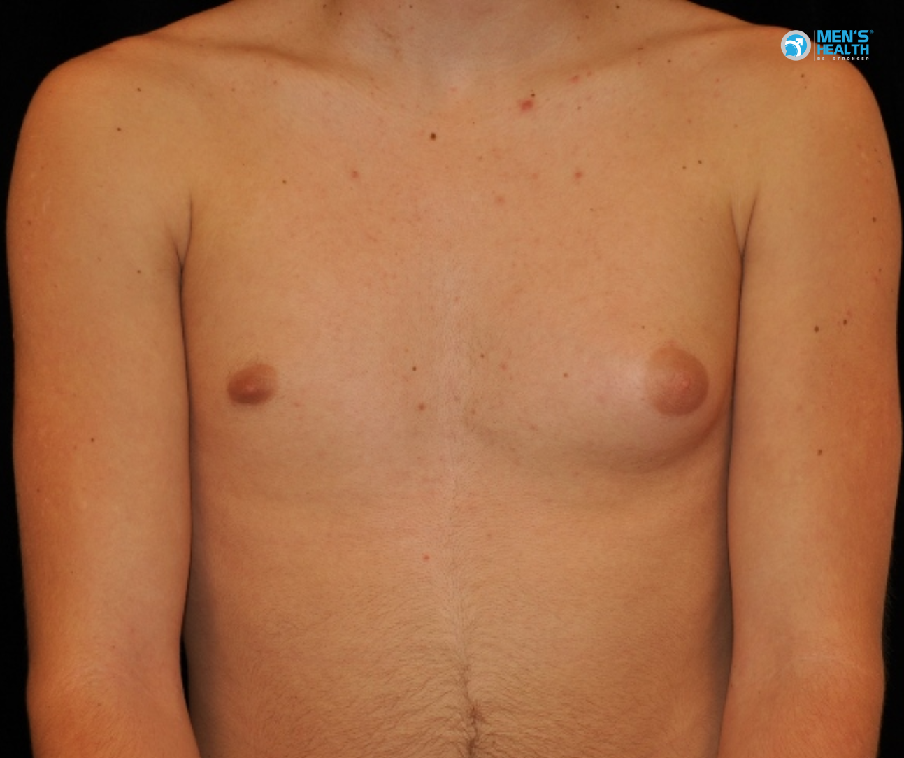 Chẩn Đoán Nữ Hóa Tuyến Vú (Gynecomastia)