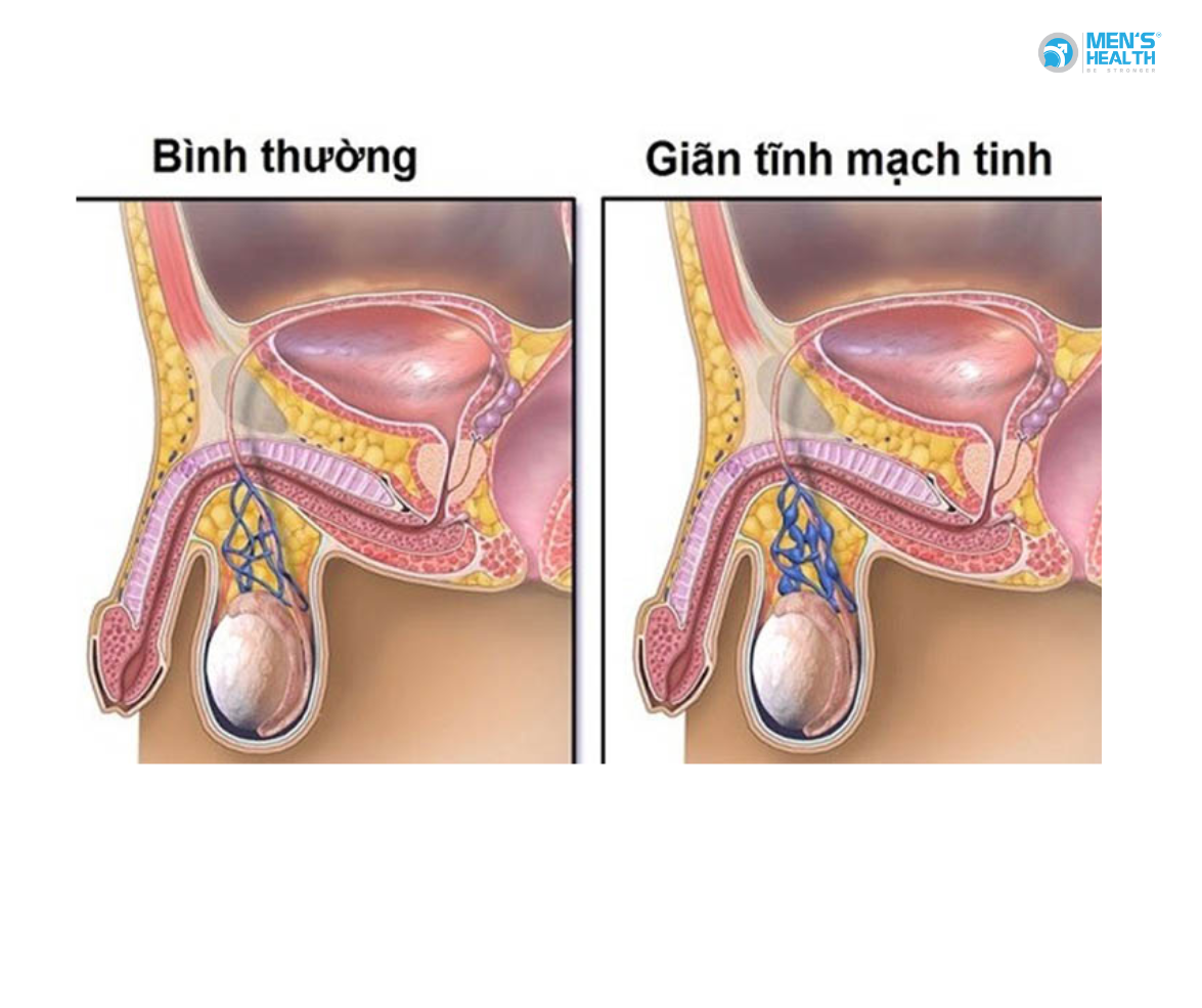 Đại Cương Về Giãn Tĩnh Mạch Thừng Tinh