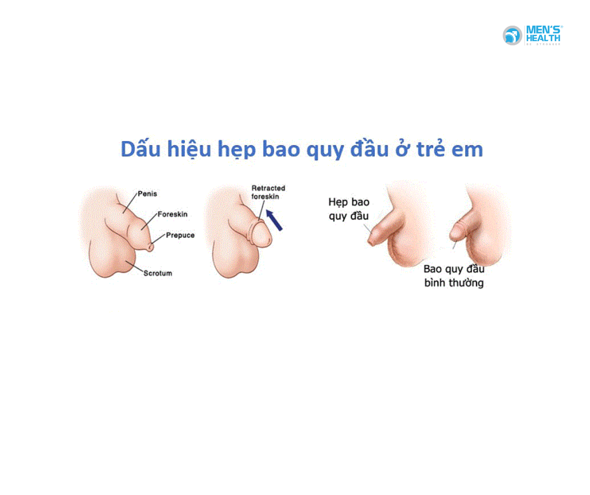 Hẹp Bao Quy Đầu Sinh Lý Ở Bé Trai: Hiện Tượng Tự Nhiên và Cách Xử Lý