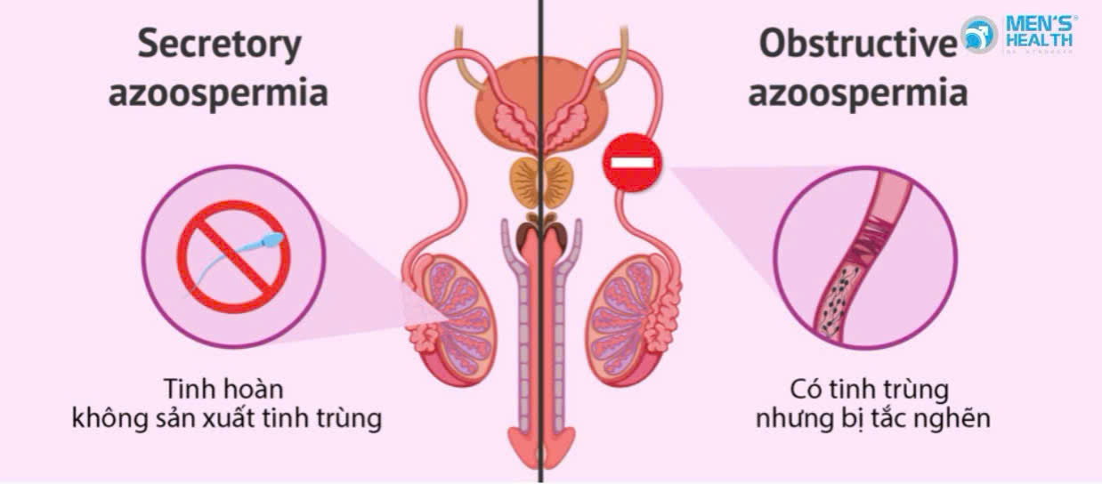 Phân Biệt Vô Tinh Bế Tắc Và Vô Tinh Không Bế Tắc ở Nam giới