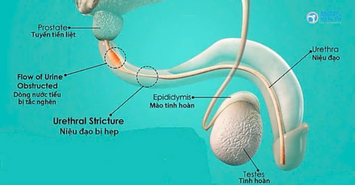 Hẹp Lỗ Tiểu Ở Nam Giới