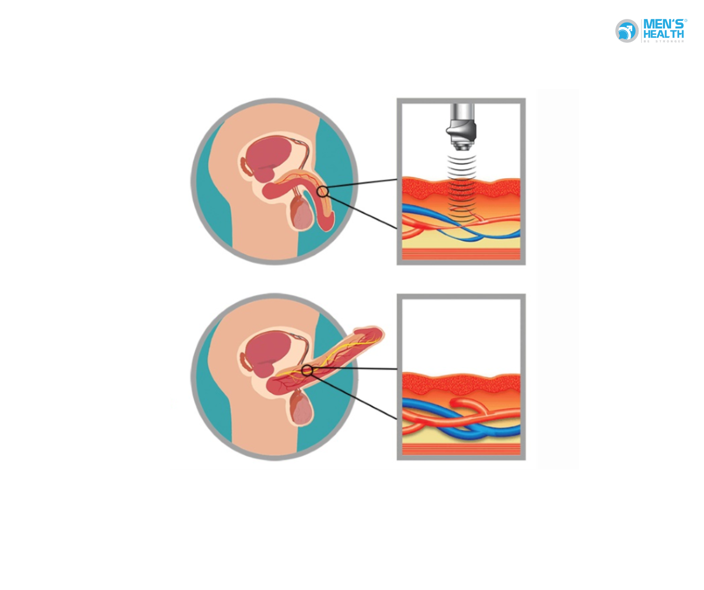 Hiệu Quả Của Sóng Xung Kích Trong Điều Trị Rối Loạn Cương Dương