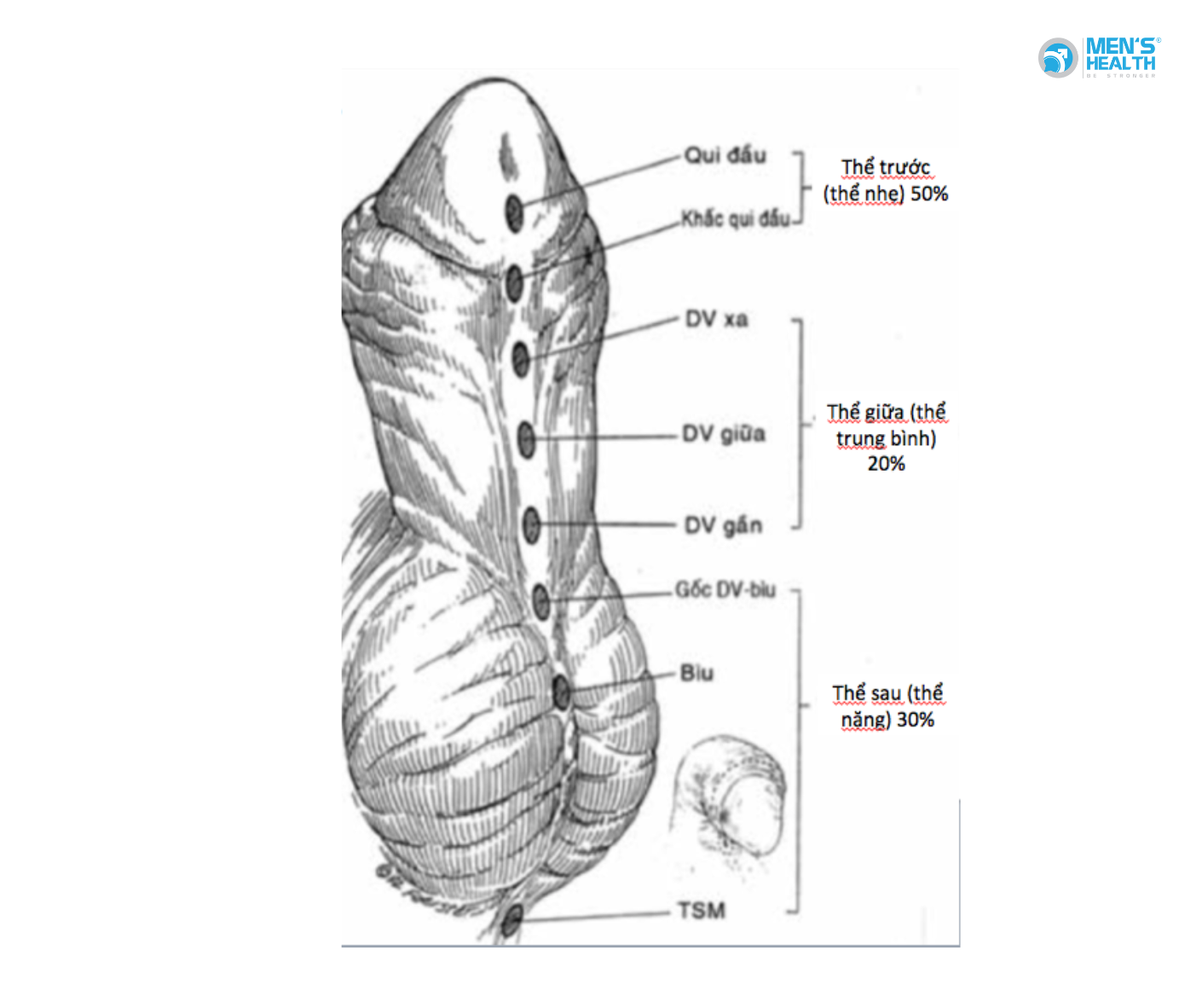 Lỗ Đái Lệch Thấp Thể Tầng Sinh Môn (Perineal Hypospadias – Q54.3)