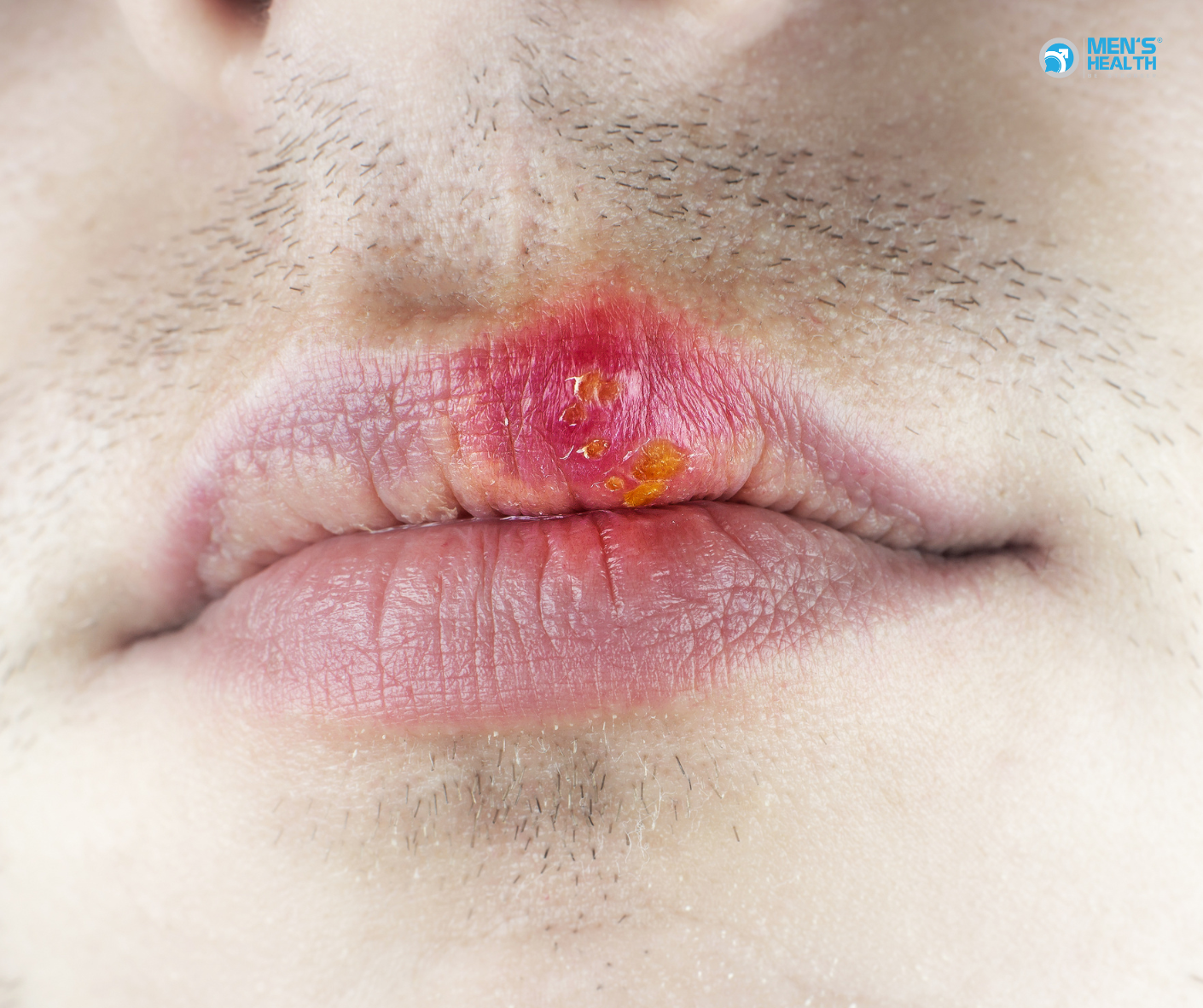 Nhiễm Herpes Simplex Virus (Hsv) Type 1 Ở Nam Giới: Tìm Hiểu Về “Mụn Rộp” Miệng Và Hơn Thế Nữa