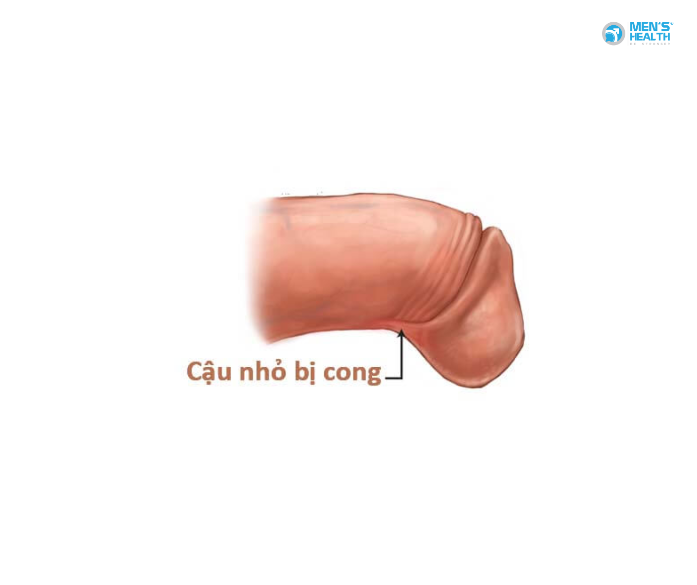 Cong Dương Vật Bẩm Sinh (Congenital Chordee – Q54.4): Khi “Cậu Nhỏ” Không Thẳng Hàng