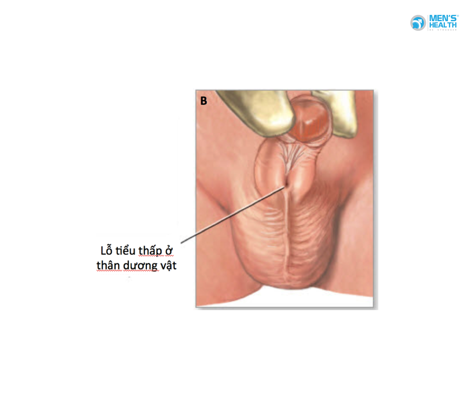 Lỗ Đái Lệch Thấp Thể Quy Đầu (Glandular Hypospadias – Q54.0): Dị Tật Bẩm Sinh Thường Gặp Ở Nam Giới