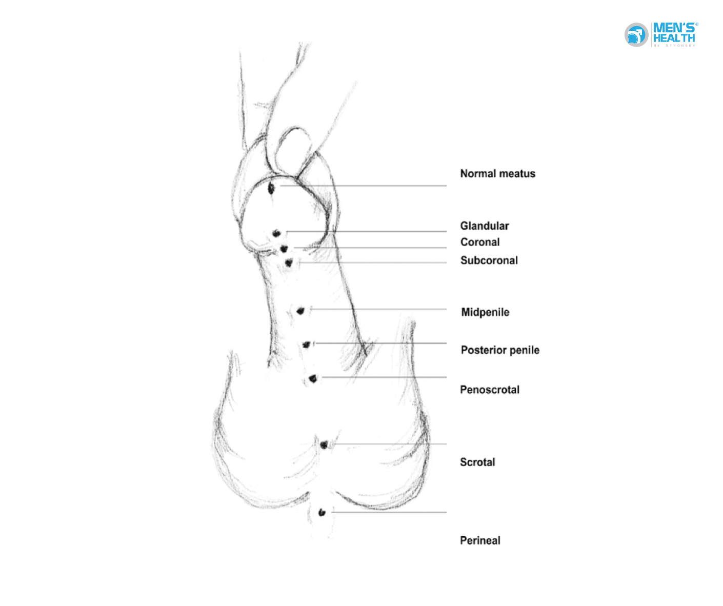 Lỗ Đái Lệch Thấp Thể Dương Vật – Bìu (Penoscrotal Hypospadias – Q54.2): Thách Thức Và Hy Vọng