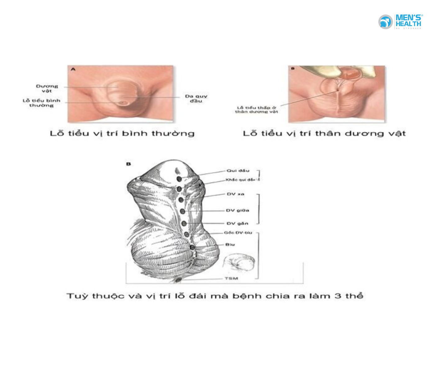 Lỗ Đái Lệch Thấp Không Đặc Hiệu (Hypospadias, Unspecified – Q54.9): Thách Thức Chẩn Đoán Và Điều Trị