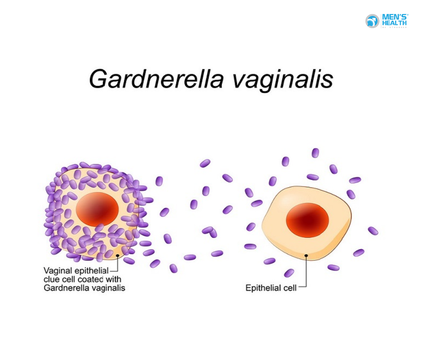 Nhiễm Gardnerella Vaginalis ở Nam Giới