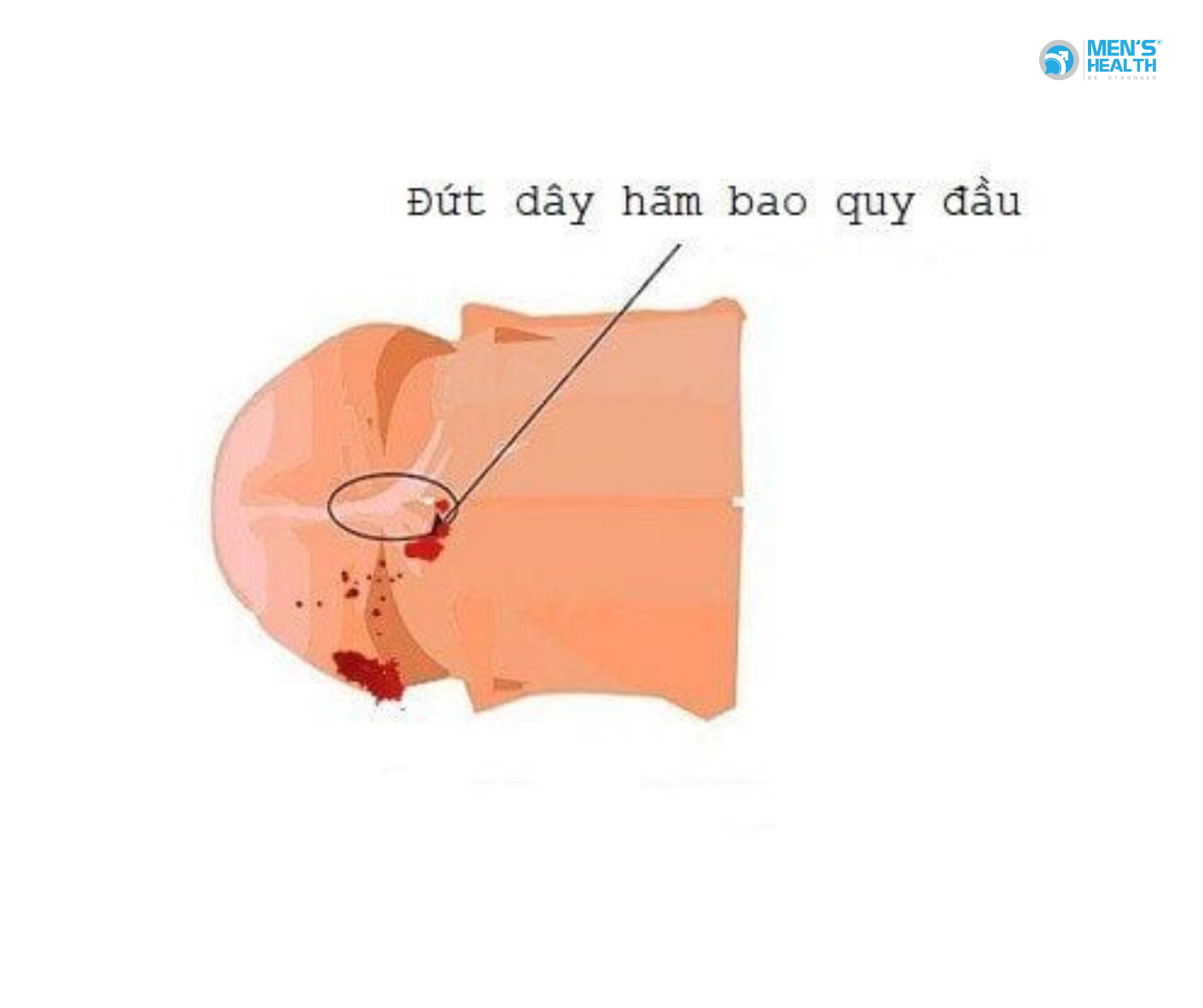 Đứt Dây Thắng Bao Quy Đầu