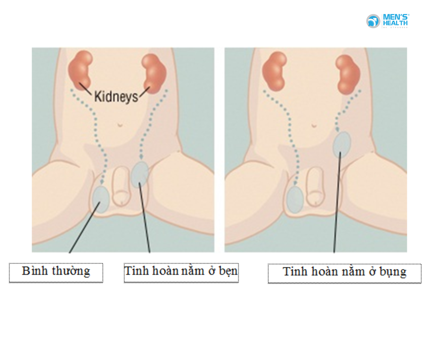 Tinh Hoàn Lạc Chỗ (Undescended Testicle – Q53)