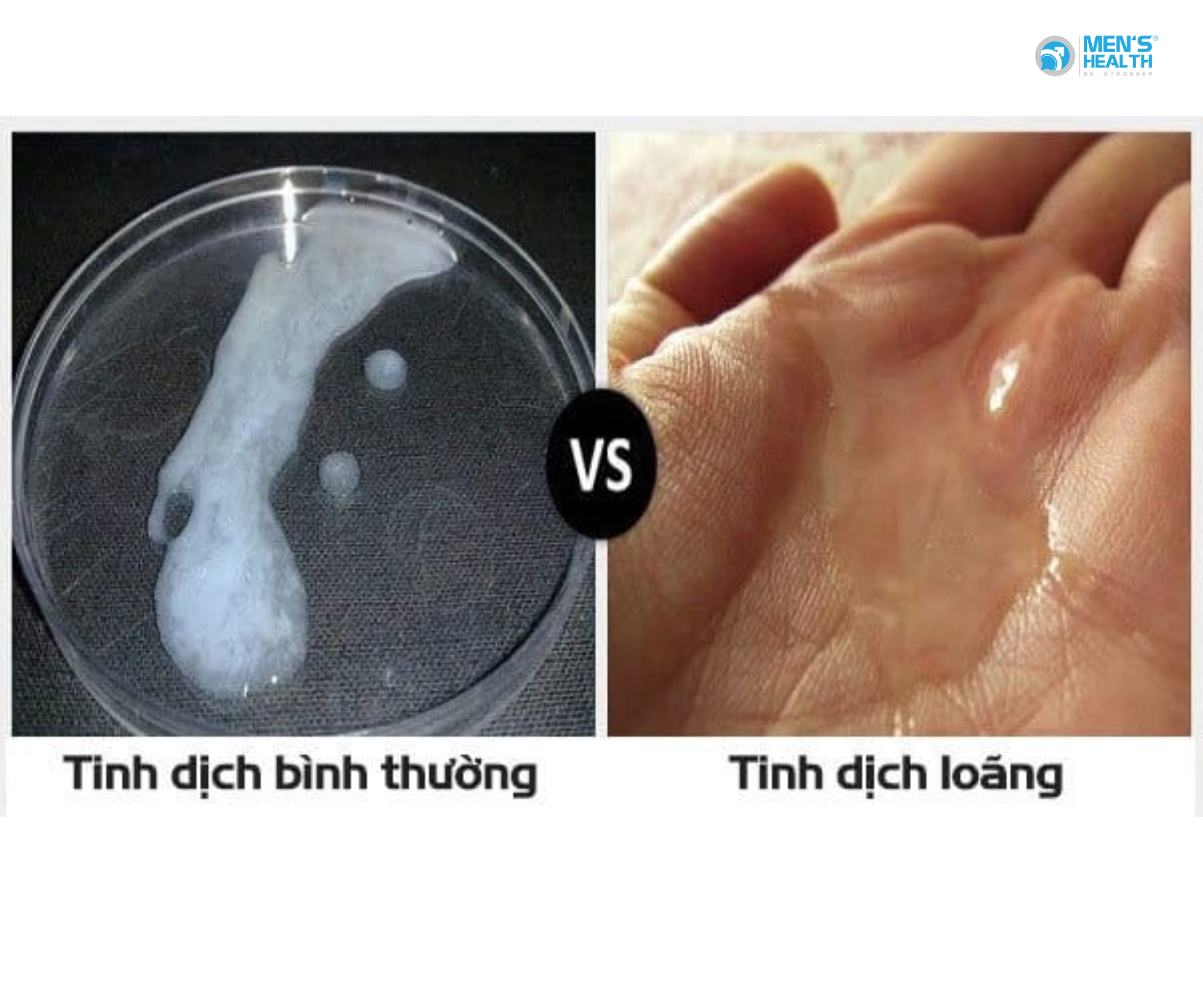 Tinh Dịch Loãng: Dấu Hiệu Cần Hiểu Đúng Trong Sức Khỏe Sinh Sản Nam Giới