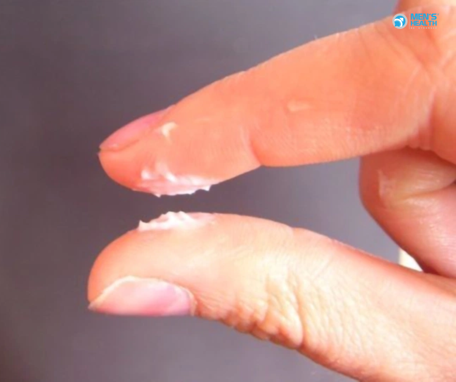 Tinh Dịch Vón Cục: Biểu Hiện Cần Cảnh Giác Trong Sức Khỏe Sinh Sản Nam Giới