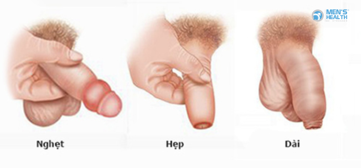 Bao Quy Đầu Dài, Hẹp Bao Quy Đầu Và Nghẹt Bao Quy Đầu (N47 – Redundant Prepuce, Phimosis And Paraphimosis)