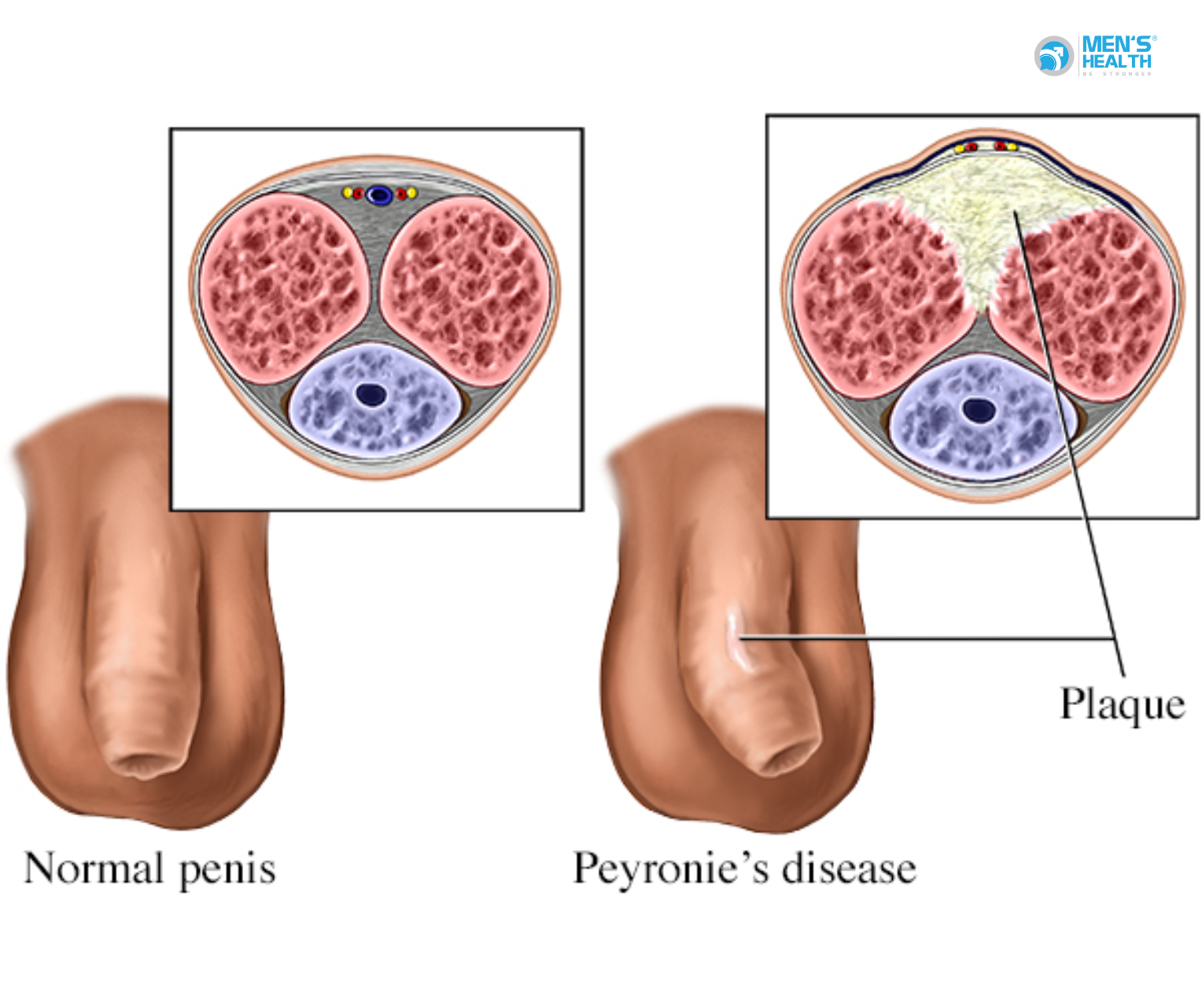 Xơ Cứng Dương Vật (N48.6 – Induratio Penis Plastica)