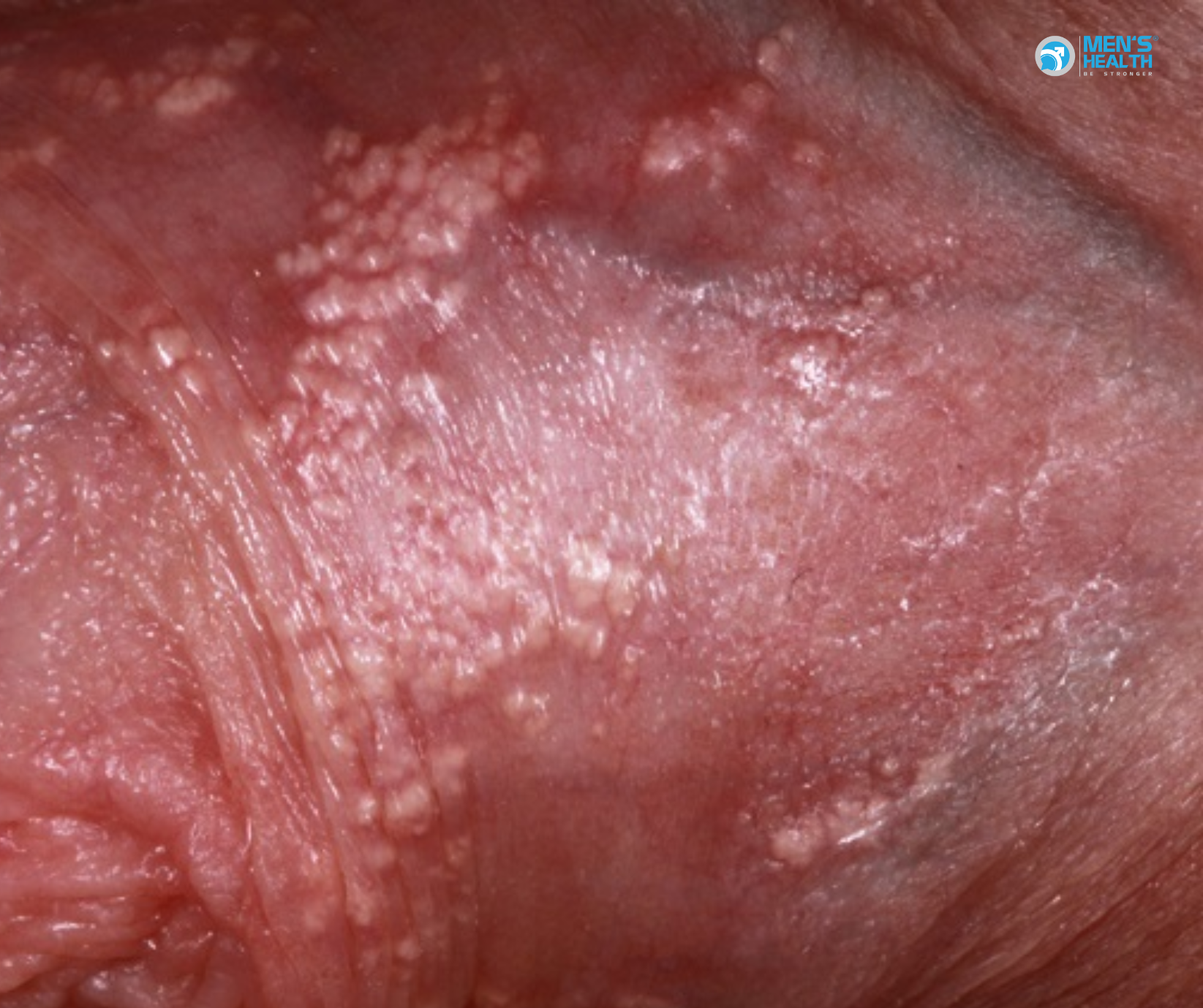 Biến Đổi Viêm Khác Của Dương Vật (N48.2 – Other Inflammatory Disorders Of Penis)