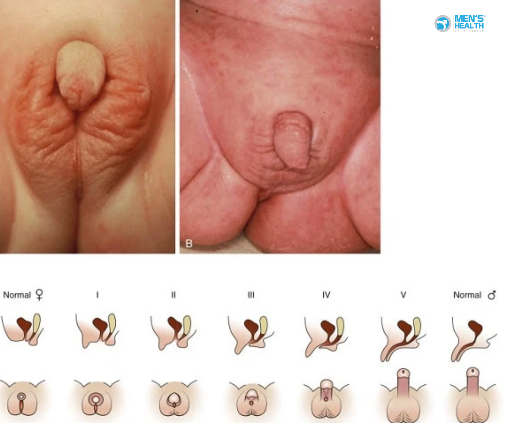 Lưỡng Giới (Hermaphroditism) – Từ Khái Niệm Cổ Điển Đến Tiếp Cận Y Học Hiện Đại