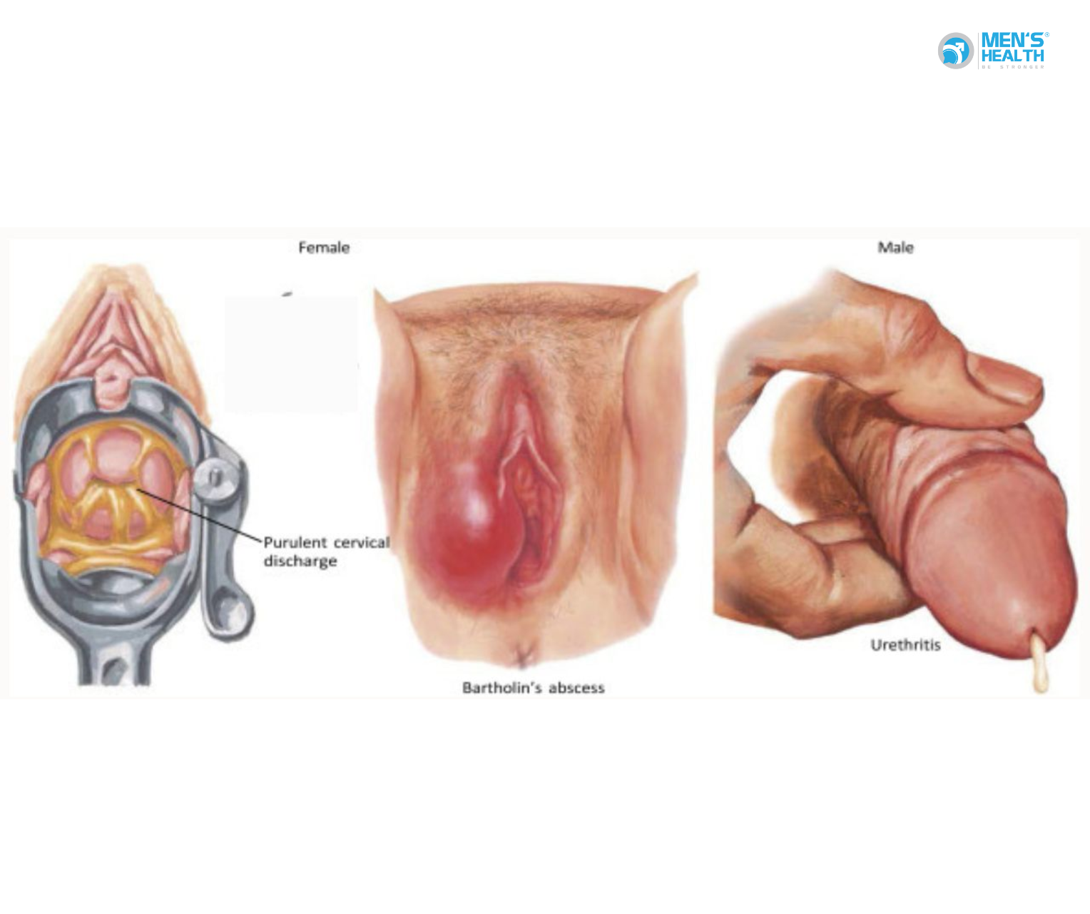Nhiễm Lậu Cầu Đường Niệu – Sinh Dục Dưới Không Có Áp Xe Quanh Niệu Đạo Hoặc Các Tuyến Phụ (A54.0)