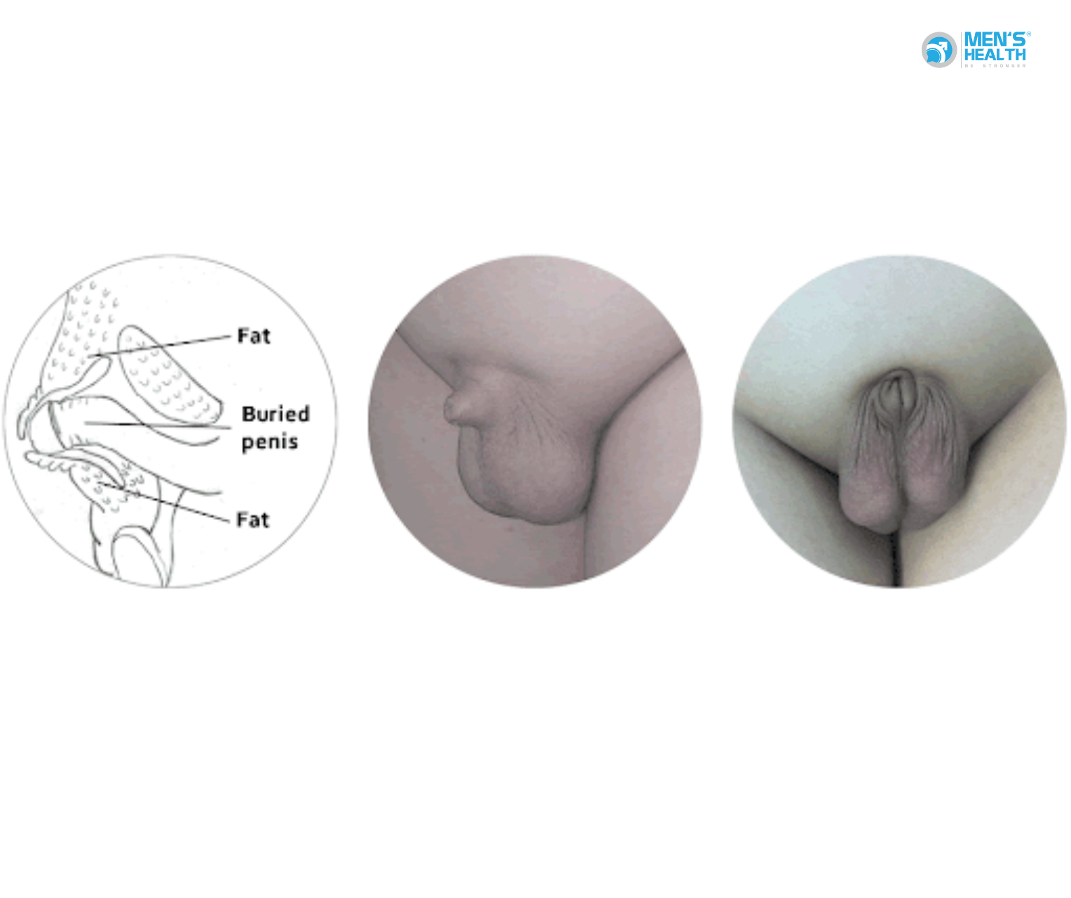 Biến Đổi Xác Định Khác Của Dương Vật (N48.8 – Other Specified Disorders Of Penis)