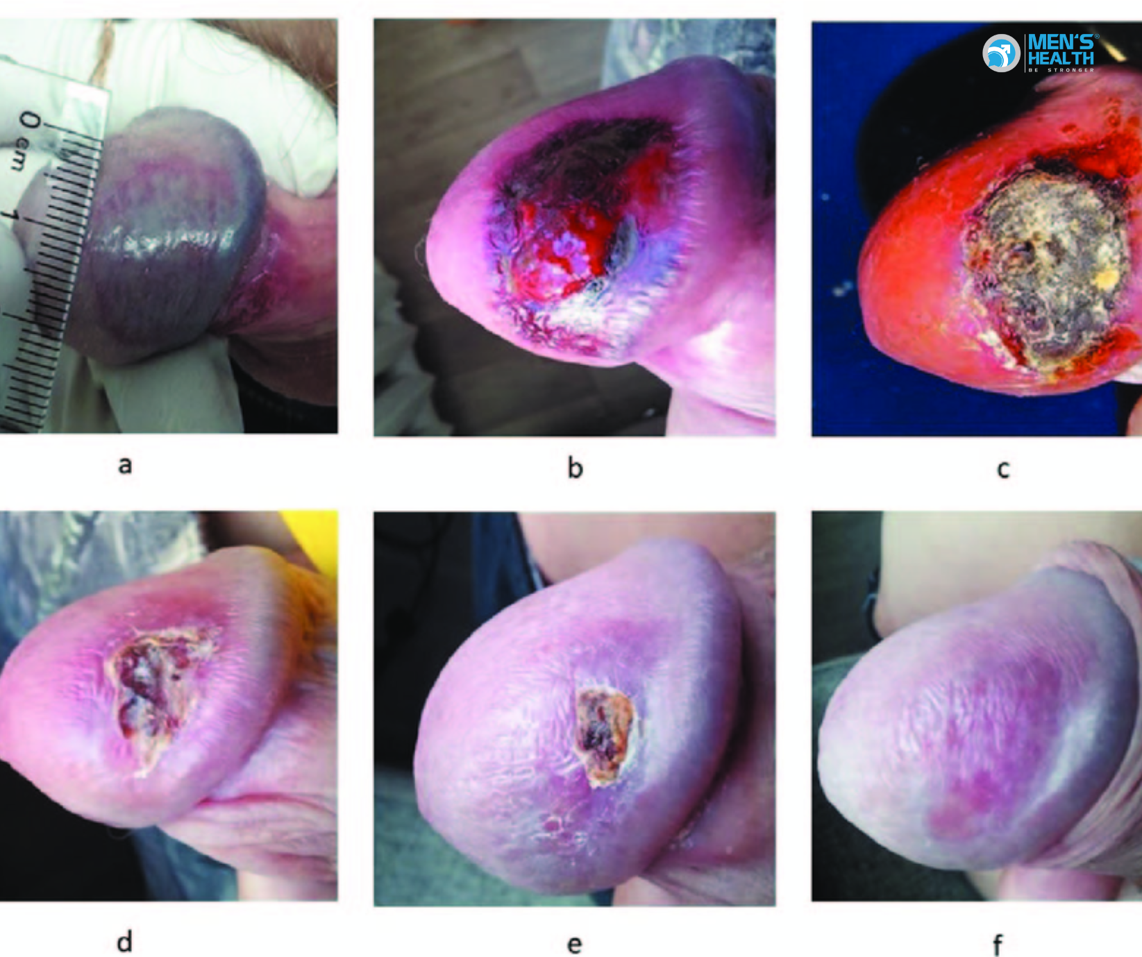 Bạch Sản Dương Vật (N48.0 – Leukoplakia Of Penis)