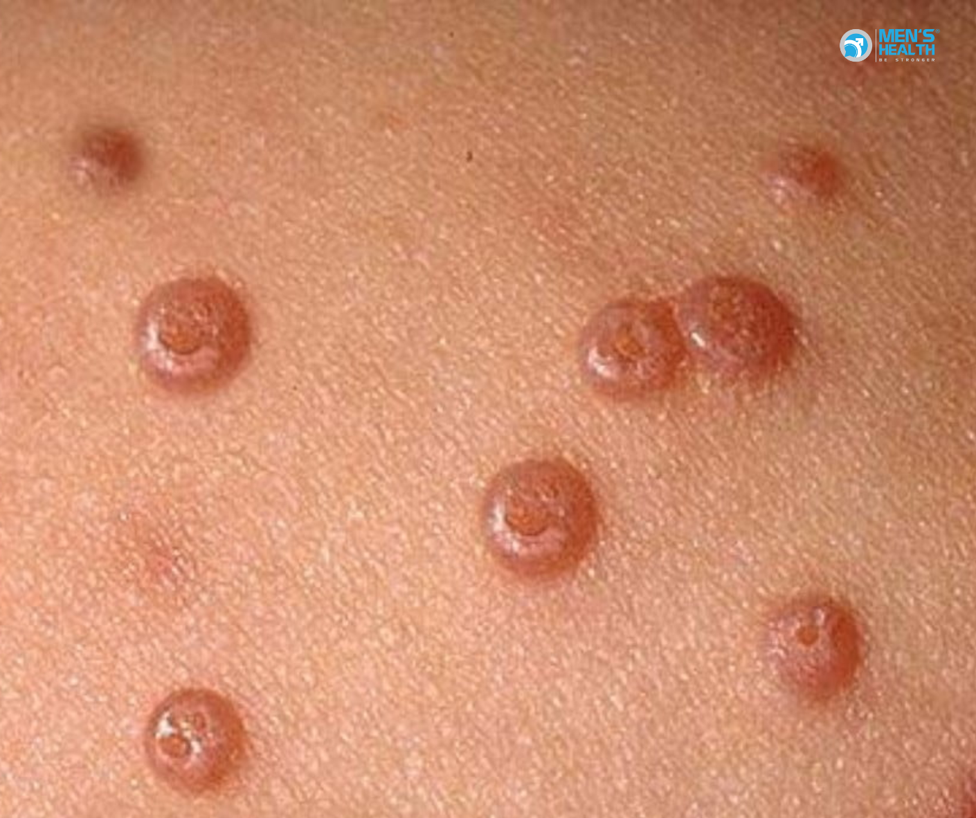 U Mềm Lây Ở Nam Giới: Chẩn Đoán, Điều Trị Và Thực Tiễn Lâm Sàng