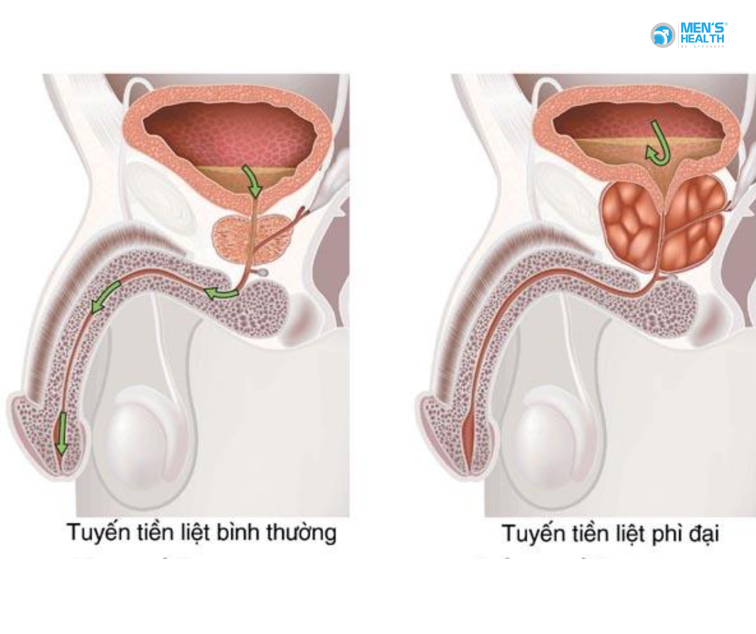 Ảnh Hưởng Của Phì Đại Lành Tính Tuyến Tiền Liệt Lên Chức Năng Sinh Lý Nam Giới