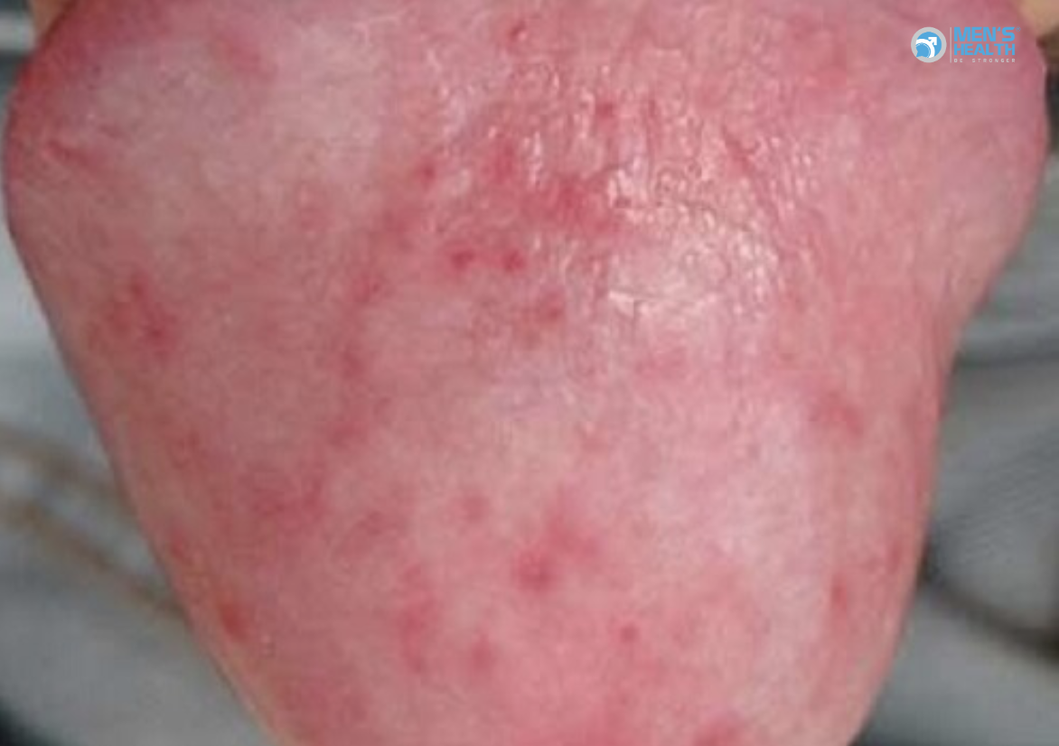 Viêm Quy Đầu – Bao Quy Đầu (N48.1 – Balanoposthitis)