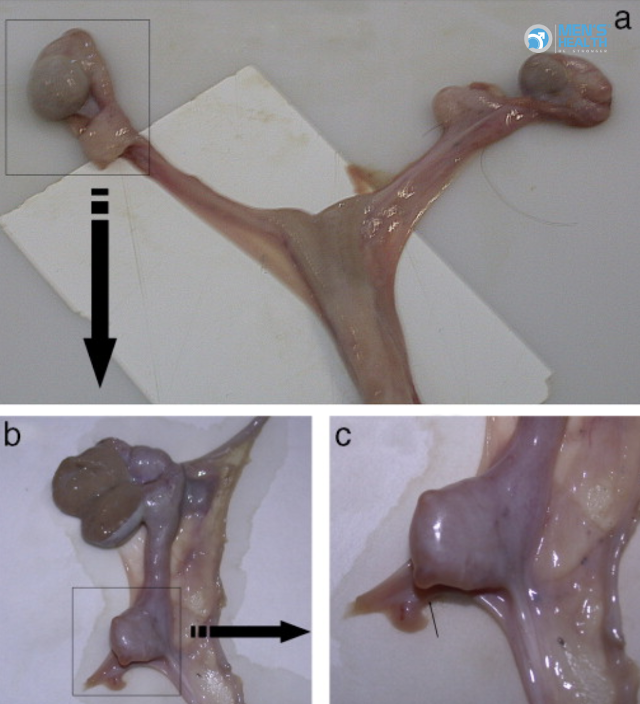 Lưỡng Giới Thật (True Hermaphroditism): Đặc Điểm, Chẩn Đoán Và Tiếp Cận Y Học Hiện Đại