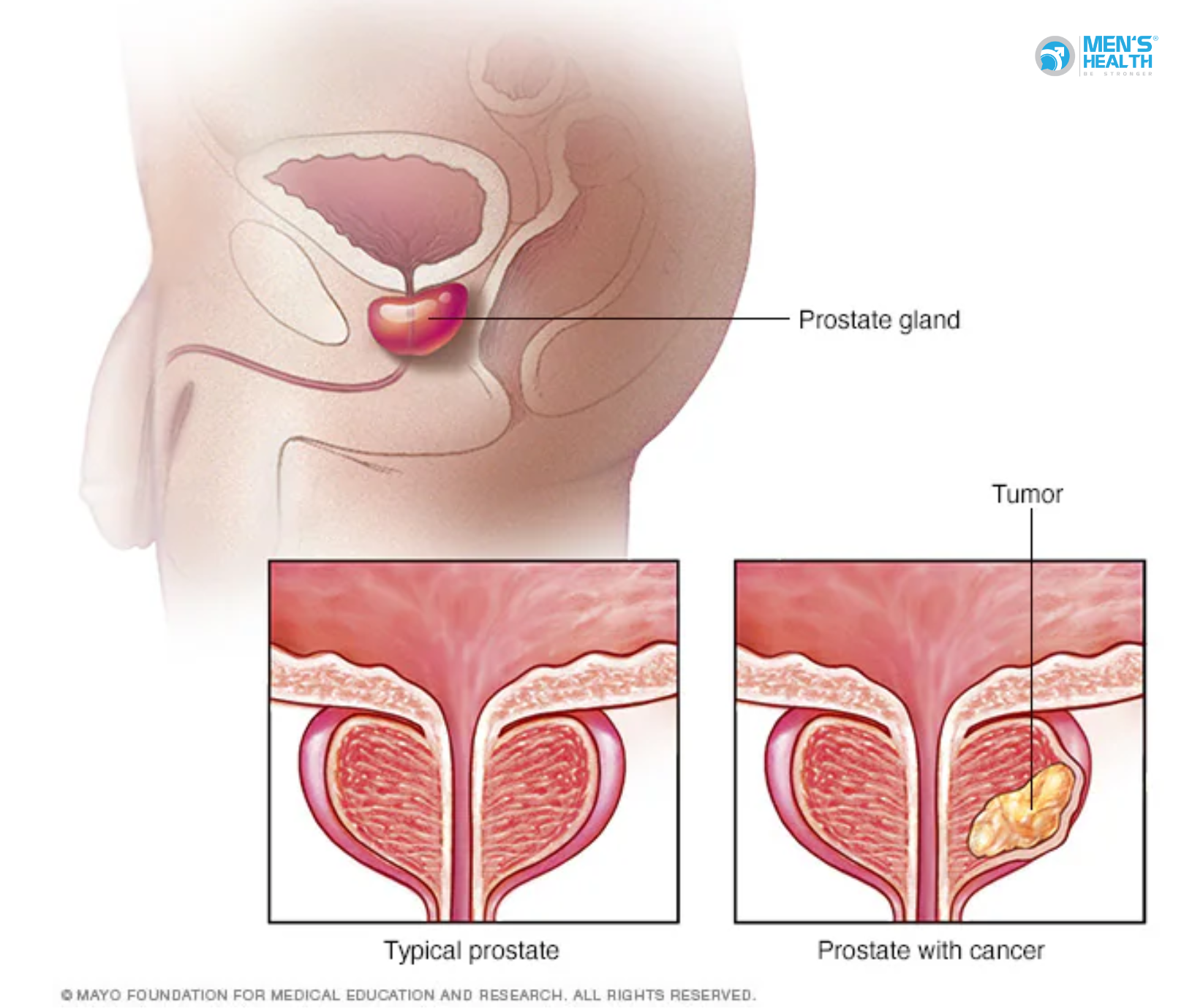 Phân Biệt Tăng Sinh Lành Tính Tuyến Tiền Liệt Và Ung Thư Tuyến Tiền Liệt