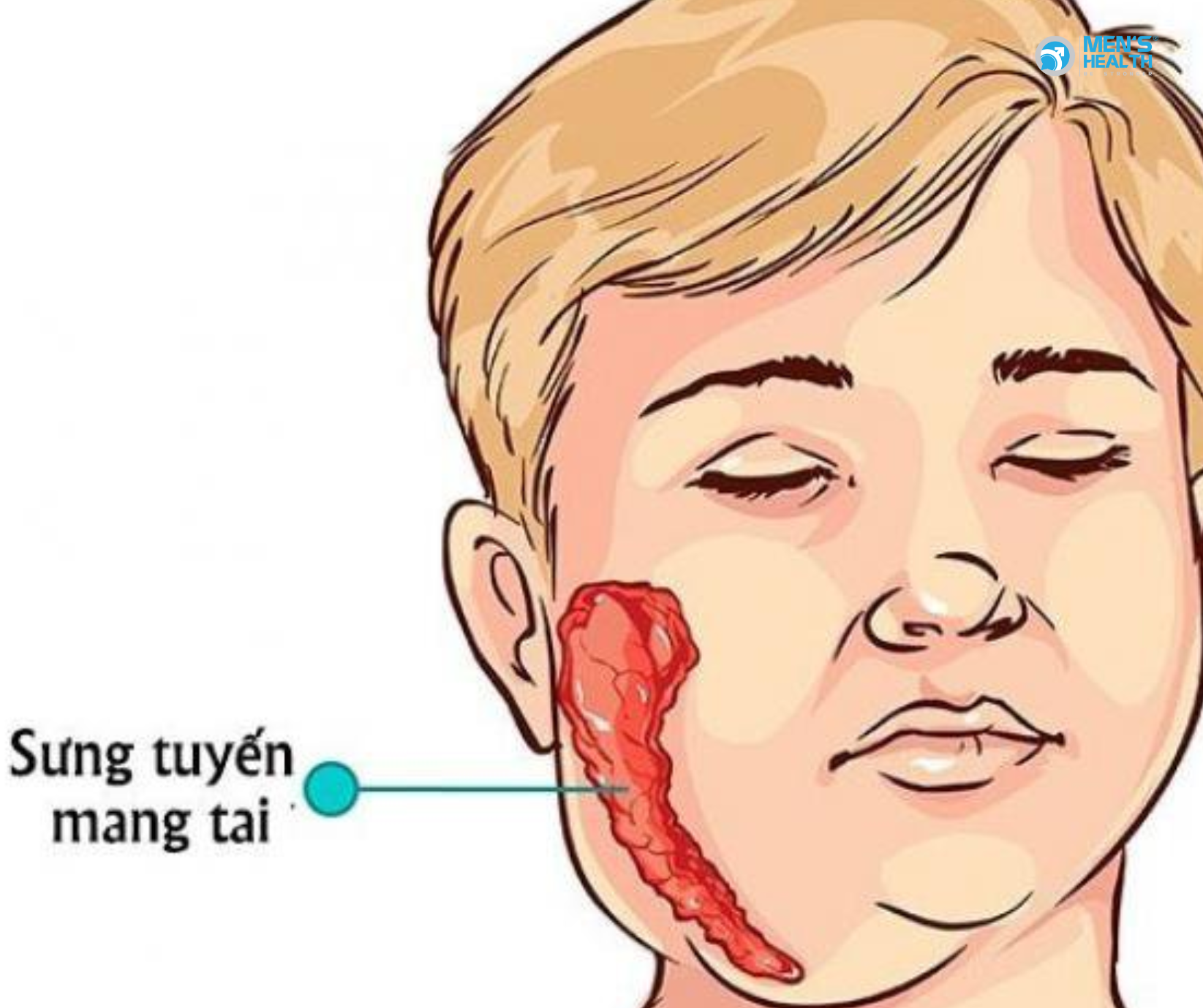 Bệnh Quai Bị Có Gây Vô Sinh Nam?