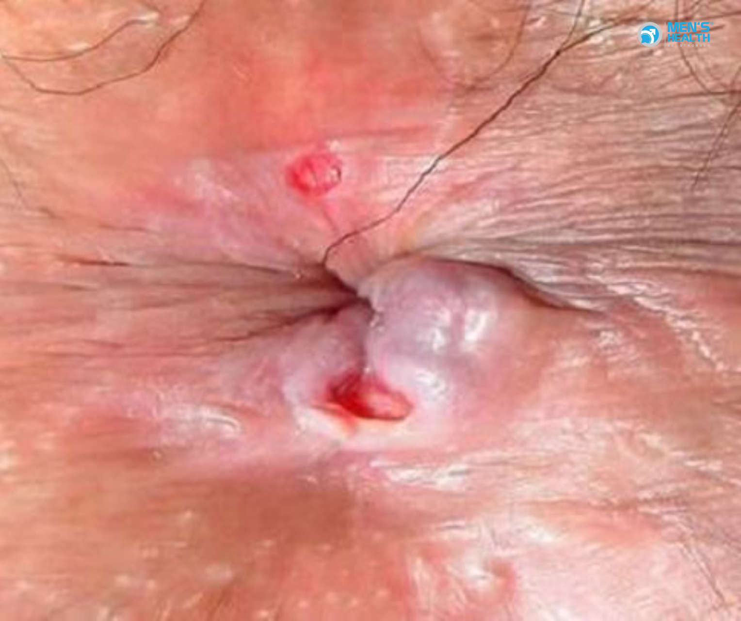 Bệnh Lậu Ở Hậu Môn Và Trực Tràng (Gonococcal Infection Of Anus And Rectum – A54.6)