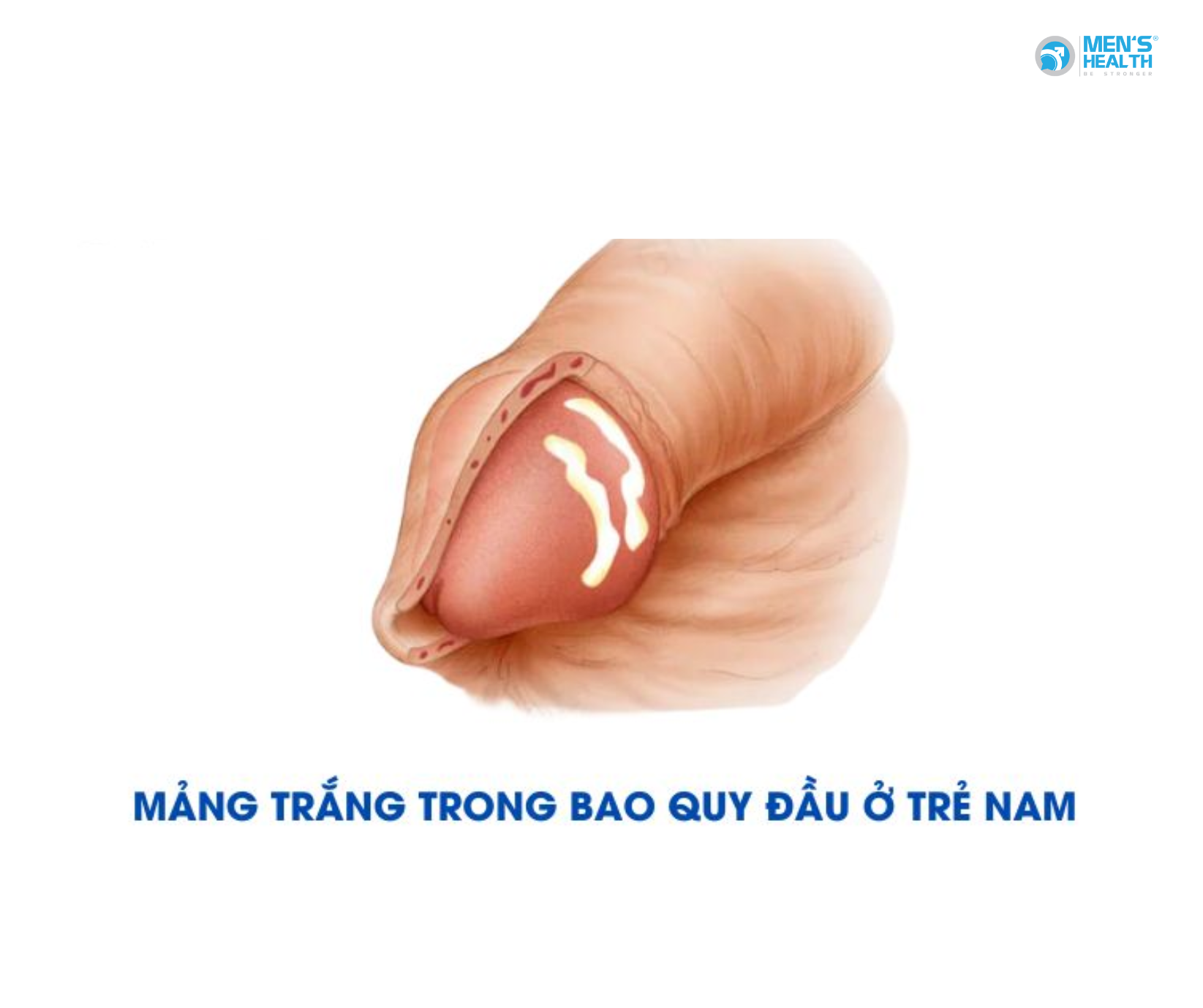 Kén Bã Quy Đầu (Smegma) Ở Trẻ Em: Hiểu Đúng Để Không Lo Sợ