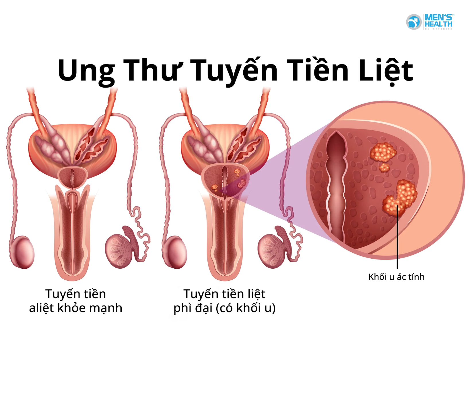 Ung Thư Tuyến Tiền Liệt Có Di Truyền Không?