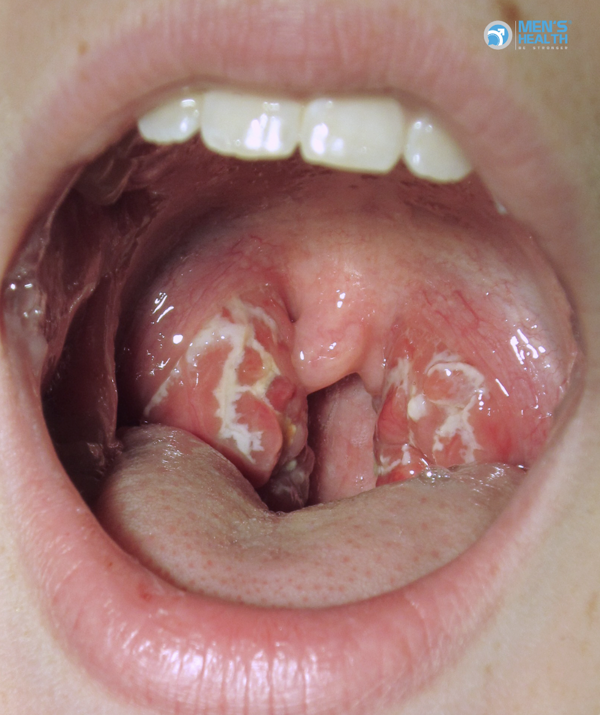 Viêm Họng Do Lậu (Gonococcal Pharyngitis – A54.5): Cảnh Báo Tàng Hình Và Nguy Cơ Lan Rộng
