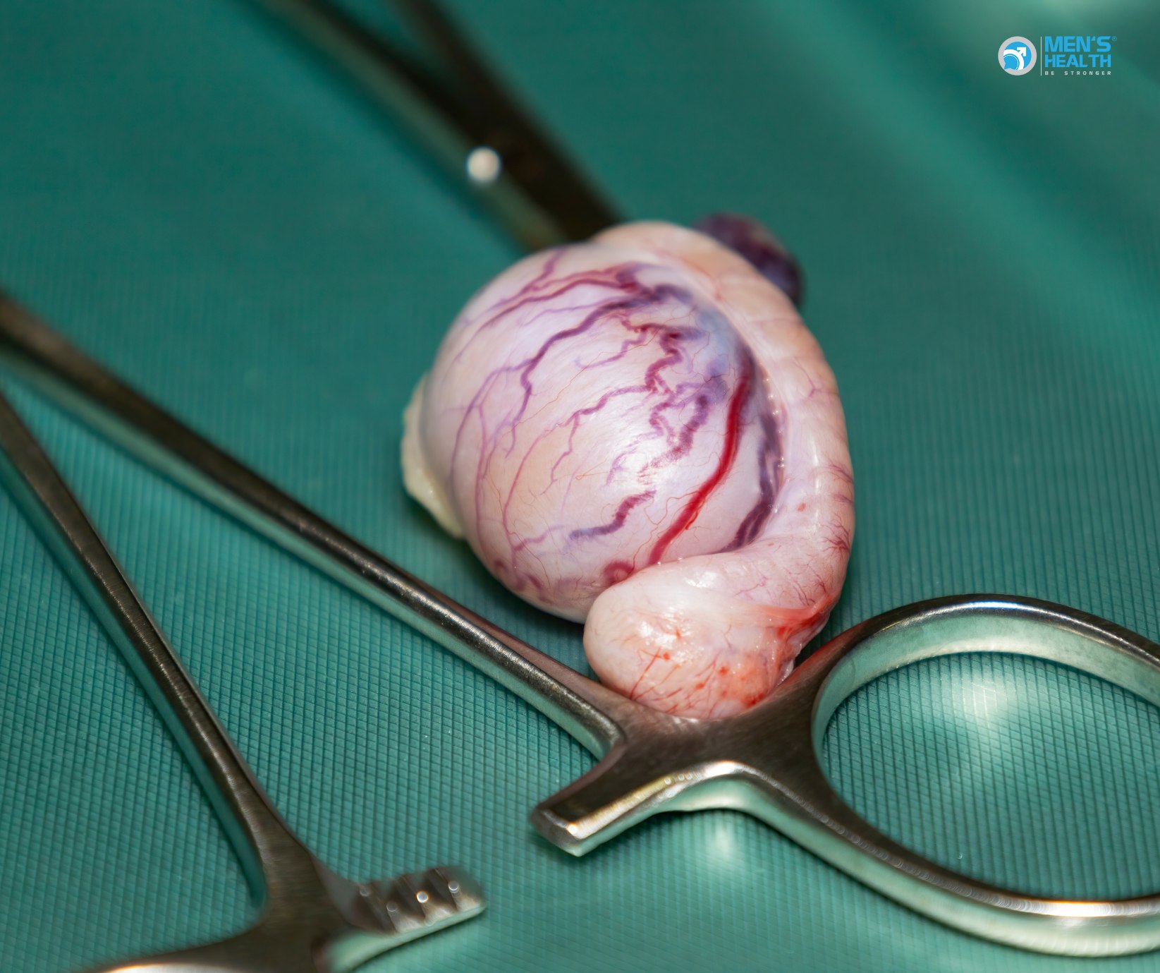 Rối Loạn Chức Năng Tinh Hoàn Khác (Other Testicular Dysfunction – E29.8)
