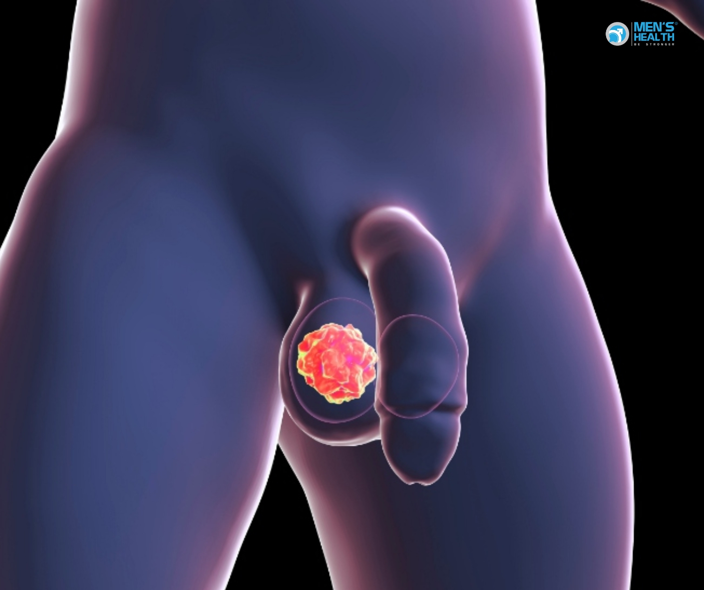 U Ác Của Cơ Quan Sinh Dục Nam Khác Và Không Xác Định (Malignant Neoplasm Of Other And Unspecified Male Genital Organs – C63)