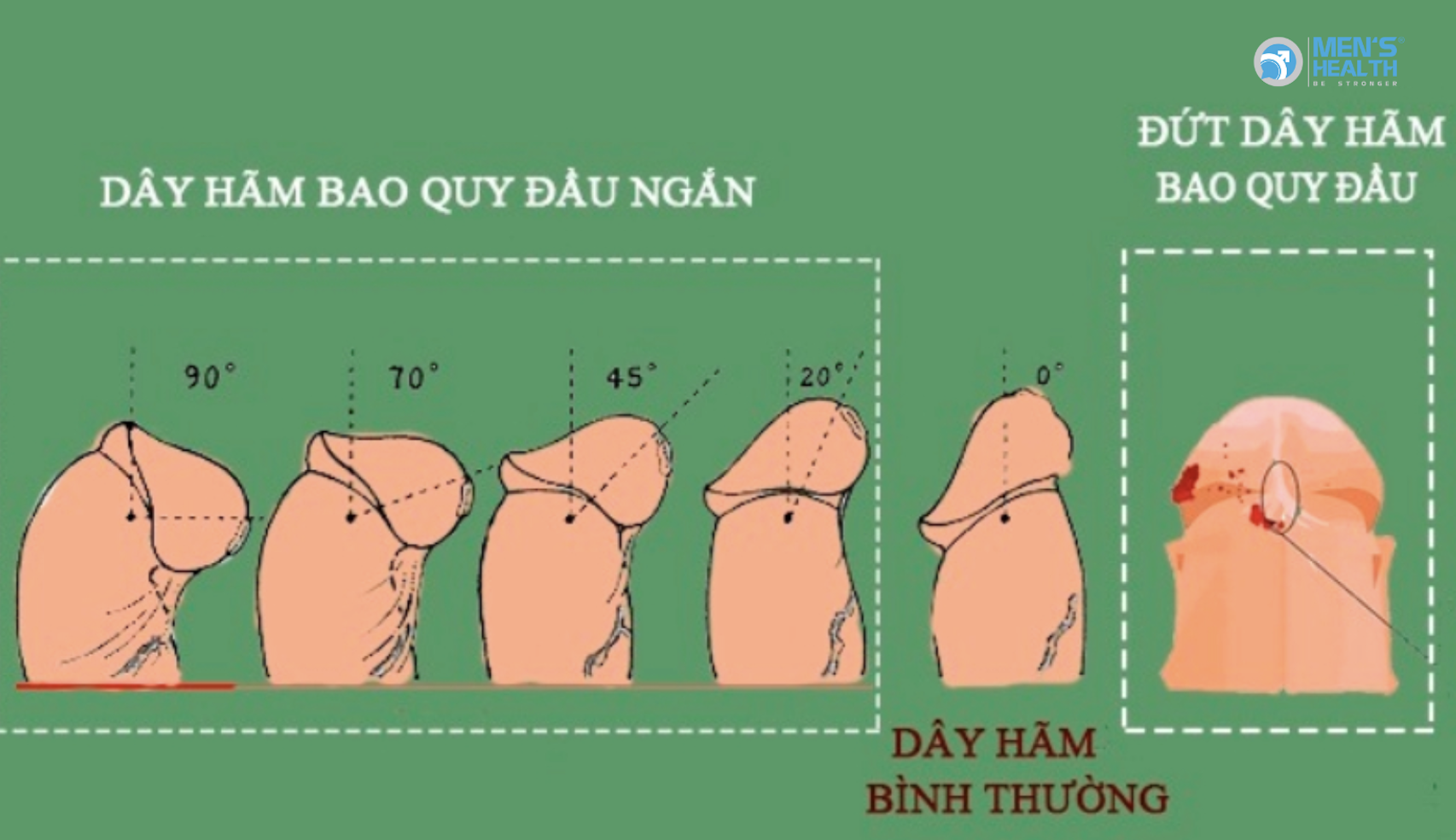 Thanh Niên Bị Đứt Phanh Khi ‘Tự Xử’: Nguyên Nhân, Hậu Quả Và Cách Xử Lý