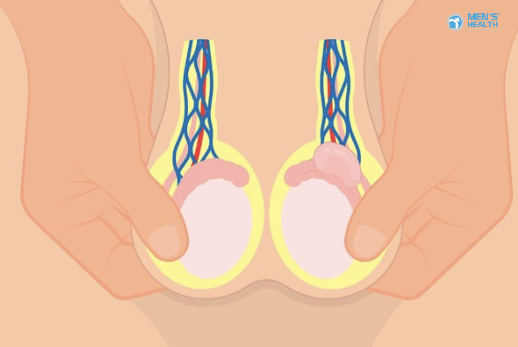 U Mỡ Lành Tính Của Thừng Tinh (Benign Lipomatous Neoplasm Of Spermatic Cord – D17.6 Theo Icd-10)