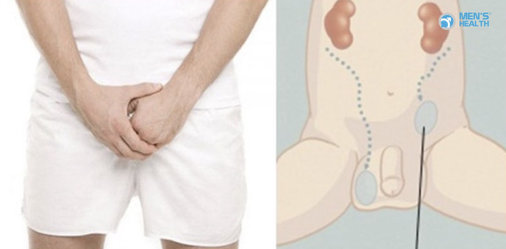 U Ác Của Tinh Hoàn Không Xuống (Malignant Neoplasm: Undescended Testis – C62.0)