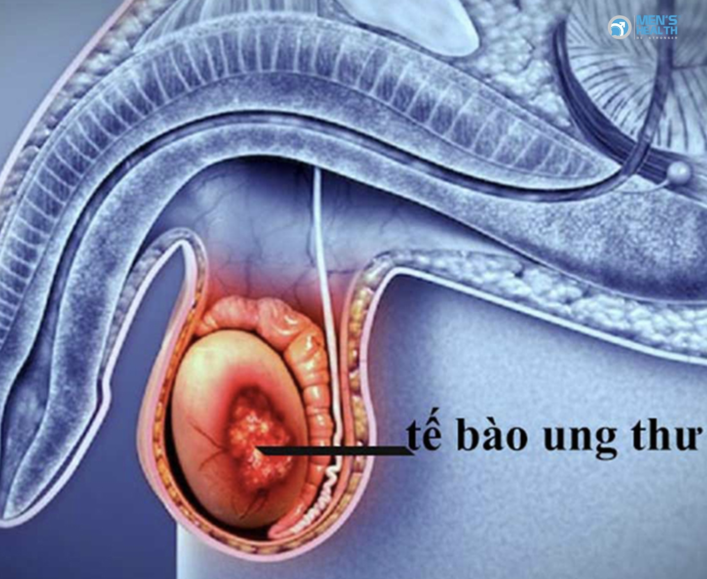 U Ác Của Tinh Hoàn Không Đặc Hiệu (Malignant Neoplasm Of Testis, Unspecified – C62.9)