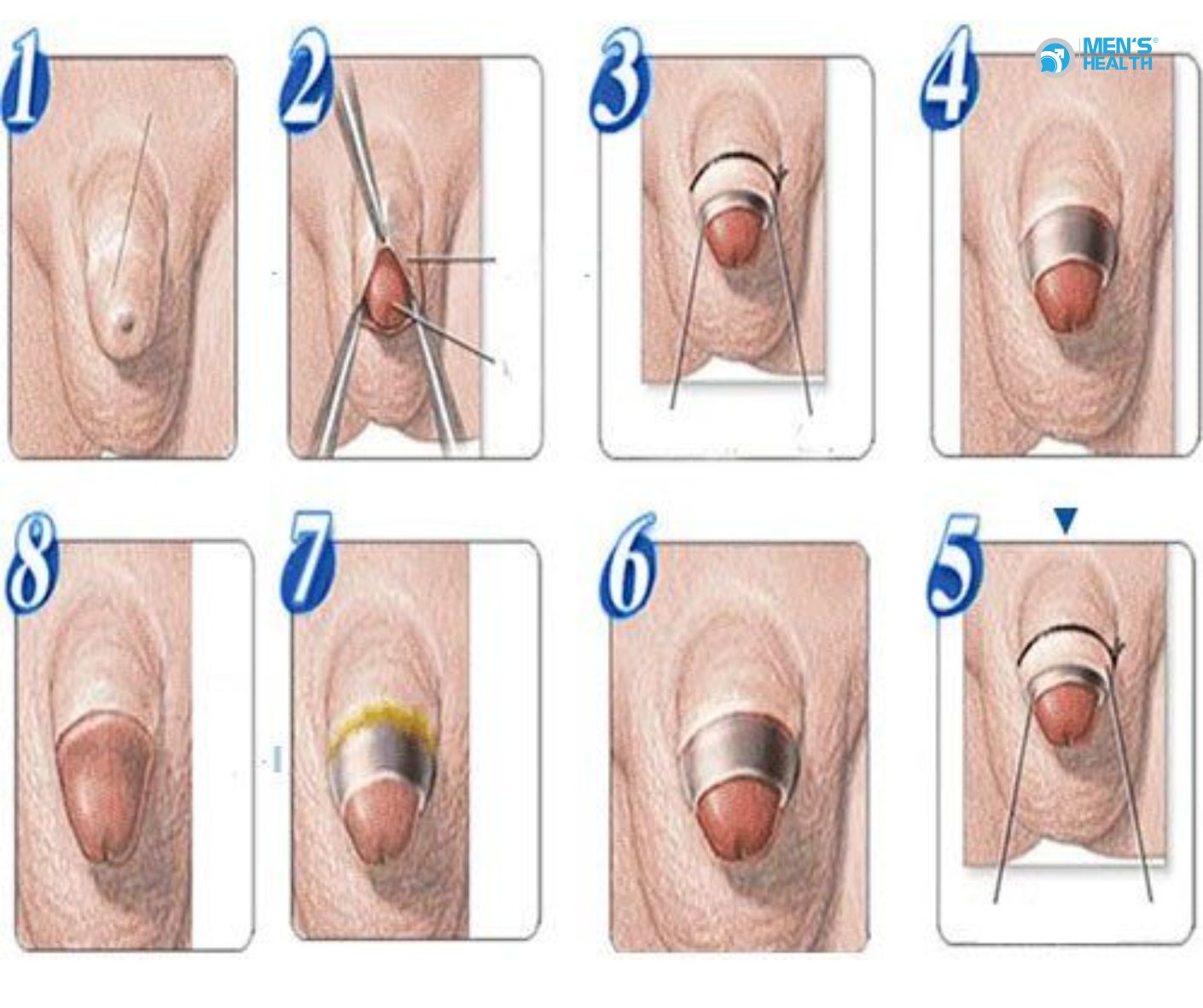 Tại Sao Cắt Bao Quy Đầu Giảm Nguy Cơ Mắc Bệnh Tình Dục?