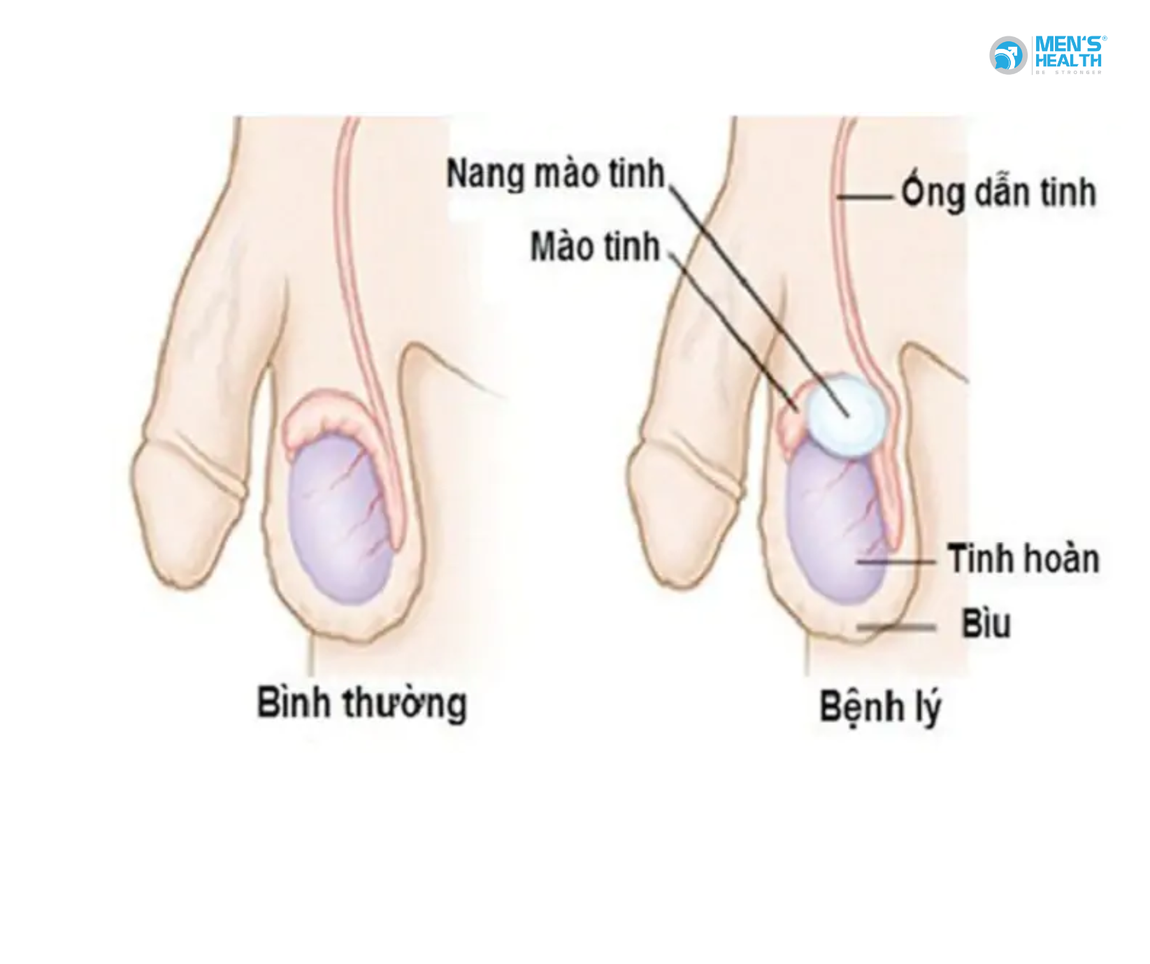 U Lành Của Mào Tinh Hoàn (Benign Neoplasm Of Epididymis – D29.3)