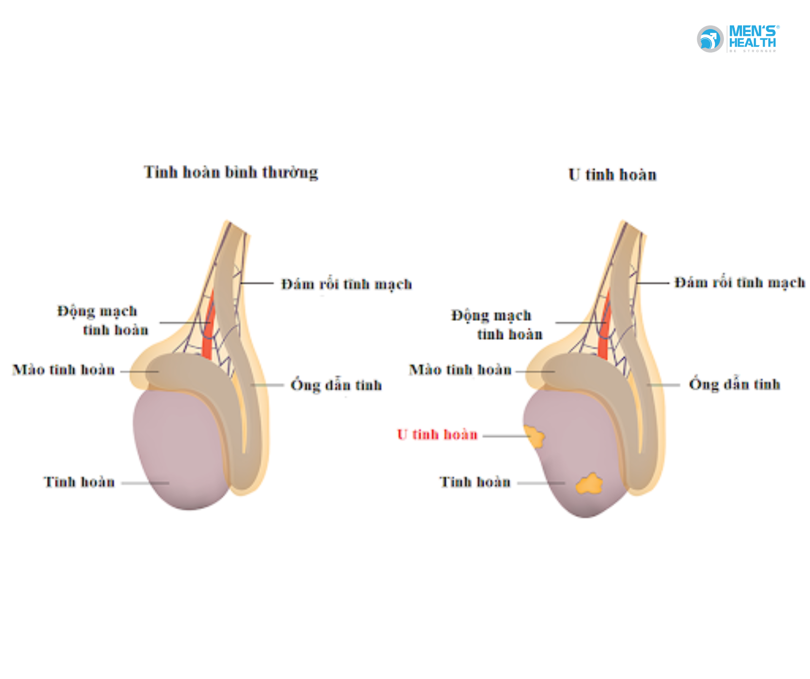 U Lành Của Bìu (Benign Neoplasm Of Scrotum – D29.4)