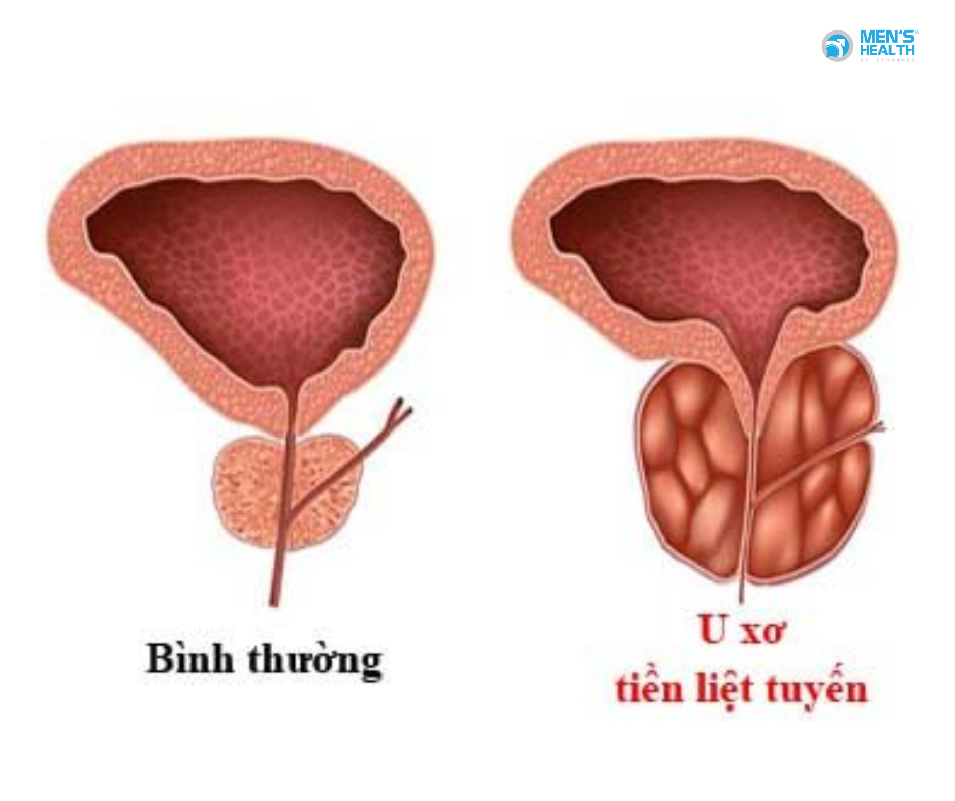 U Lành Của Tuyến Tiền Liệt (Benign Neoplasm Of Prostate – D29.1)