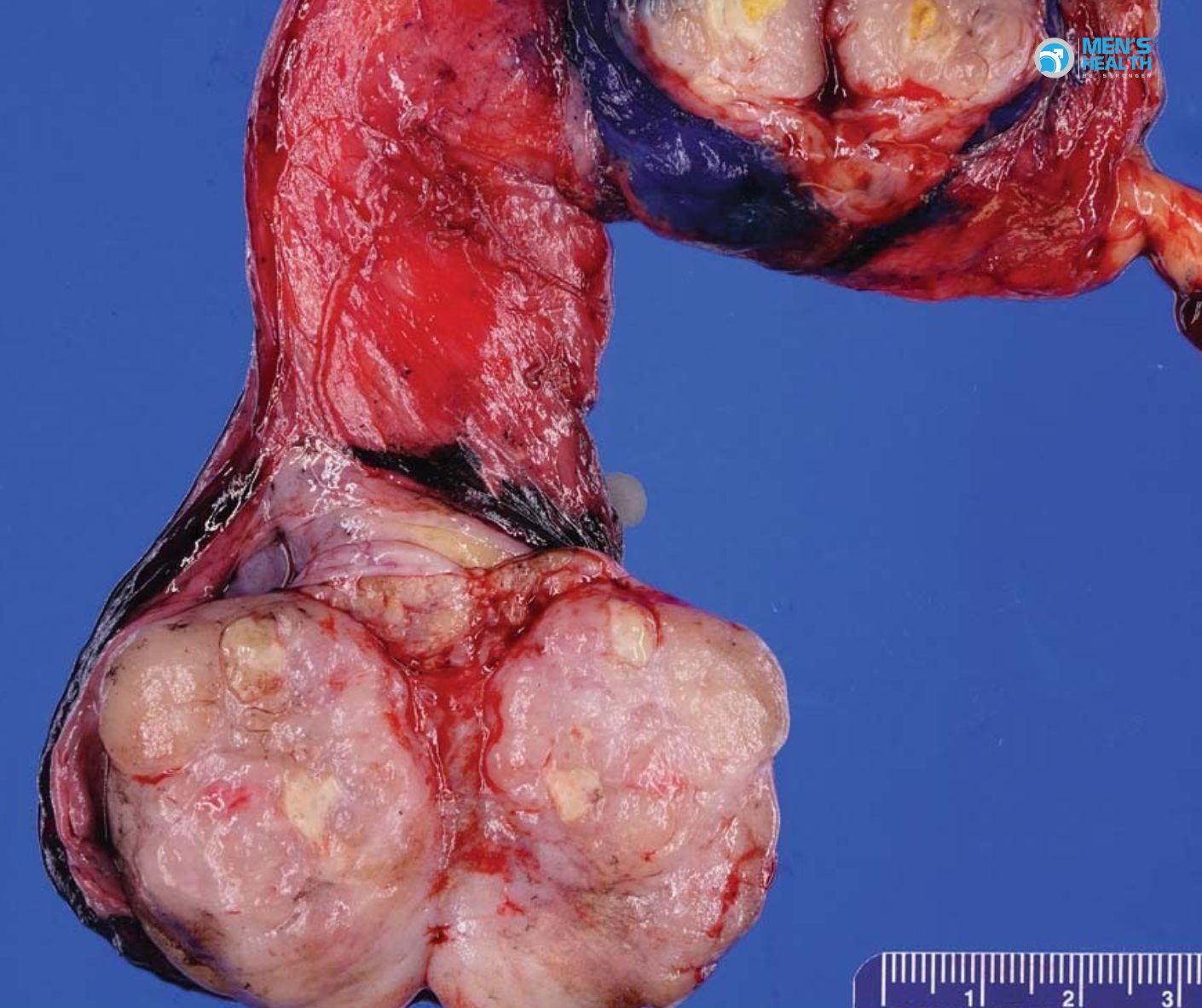 U Ác Của Thừng Tinh (Malignant Neoplasm of Spermatic Cord – C63.1)