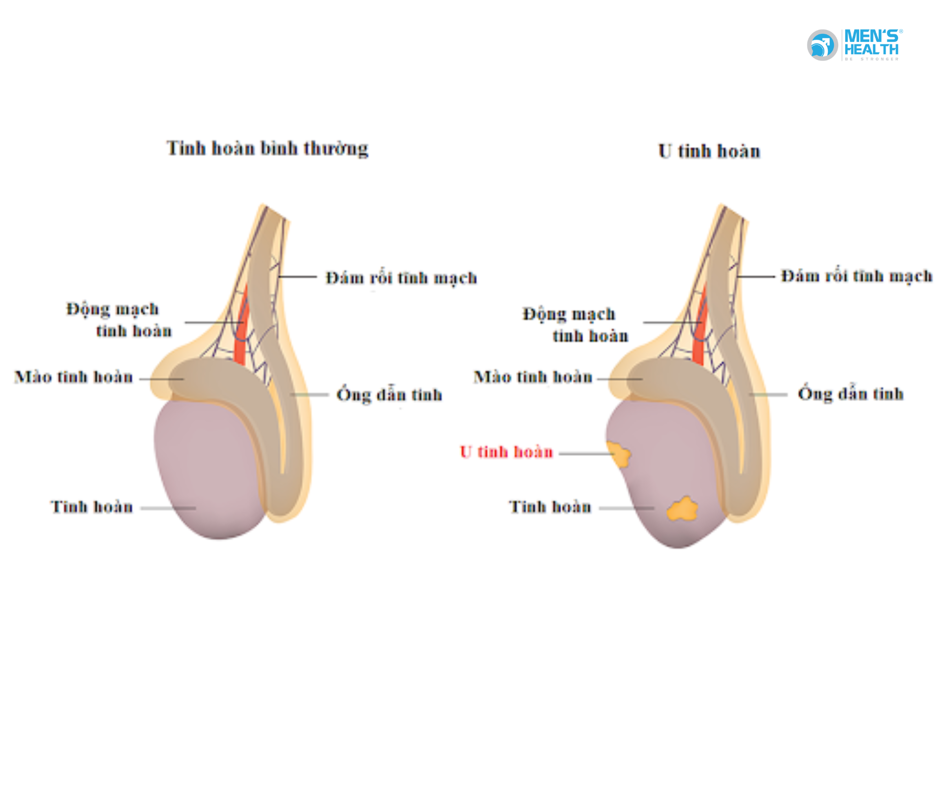 U Lành Của Tinh Hoàn (Benign Neoplasm Of Testis – D29.2)