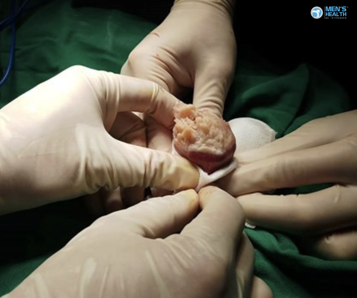 U Ác Của Cơ Quan Sinh Dục Nam Không Xác Định (Malignant Neoplasm: Male Genital Organ, Unspecified – C63.9)
