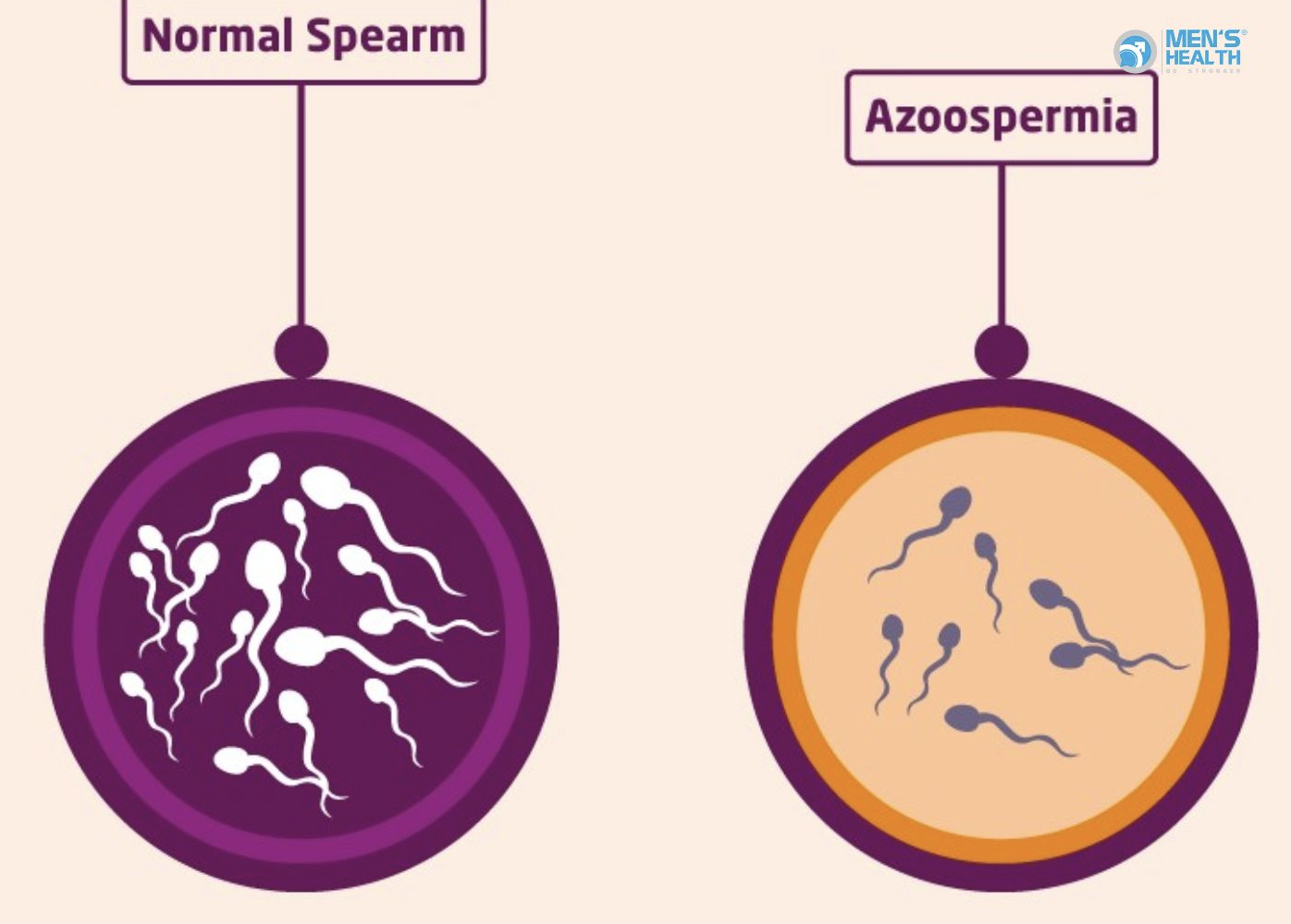 Cập Nhật Chẩn Đoán Và Điều Trị Vô Sinh Không Tắc Nghẽn (Non-Obstructive Azoospermia – NOA)